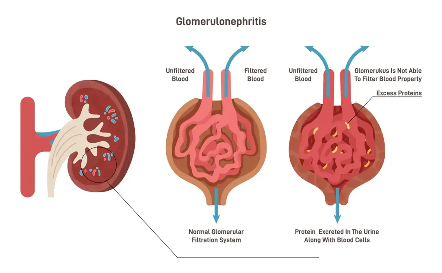 Glomerulonephritis Management