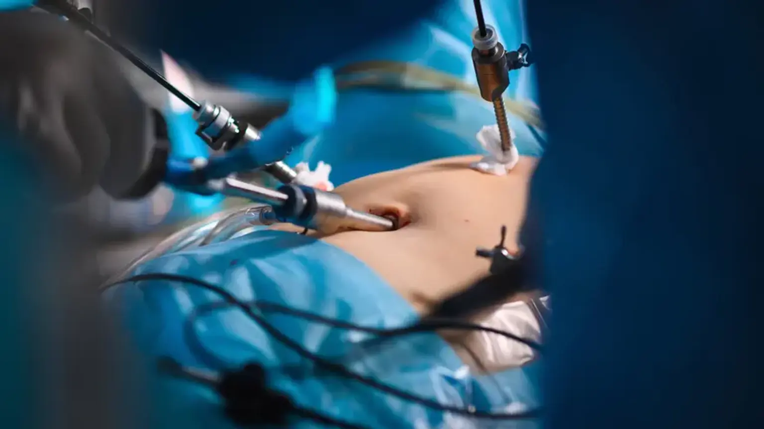 HIPEC Cancer Treatment