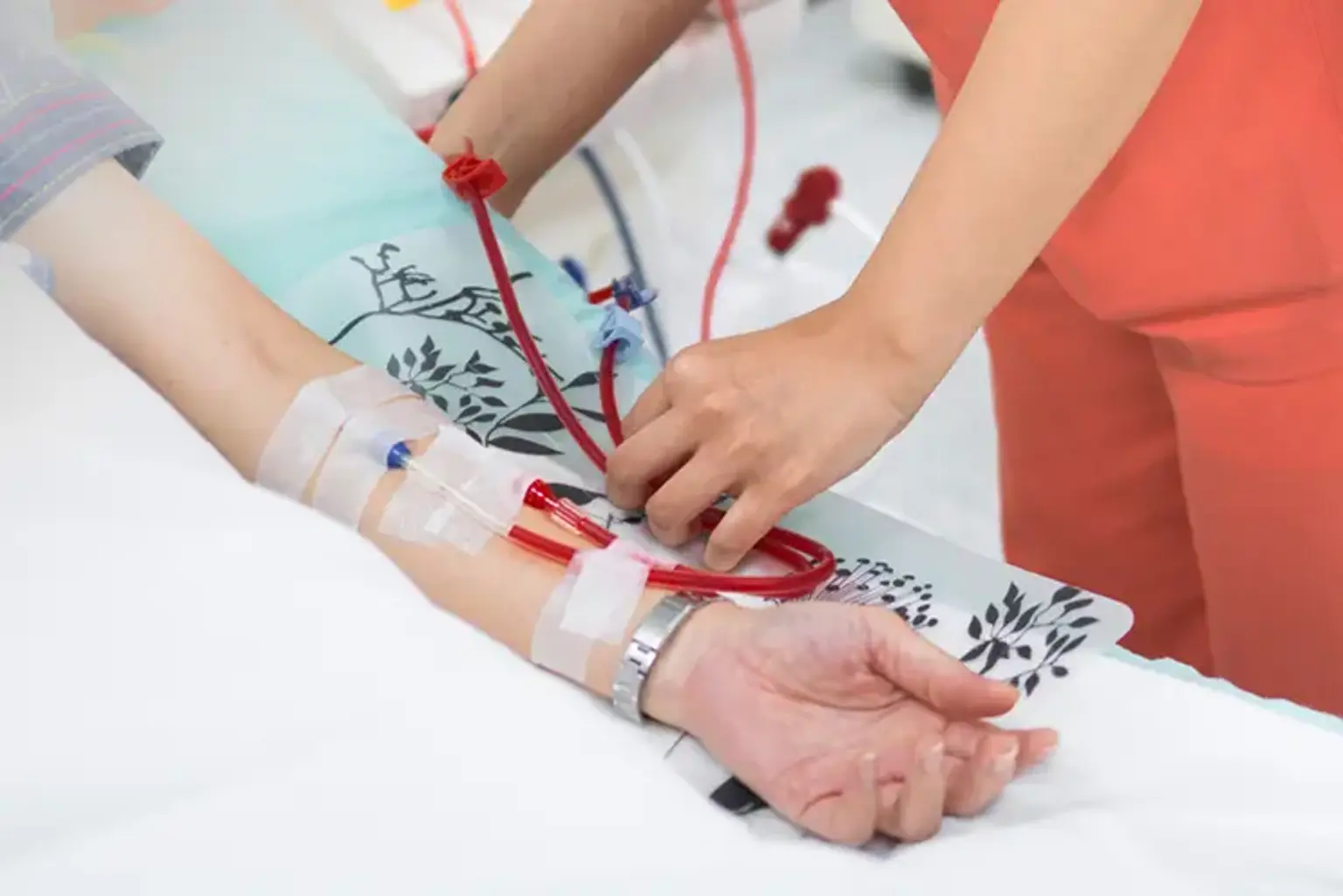 Arteriovenous Fistula Creation