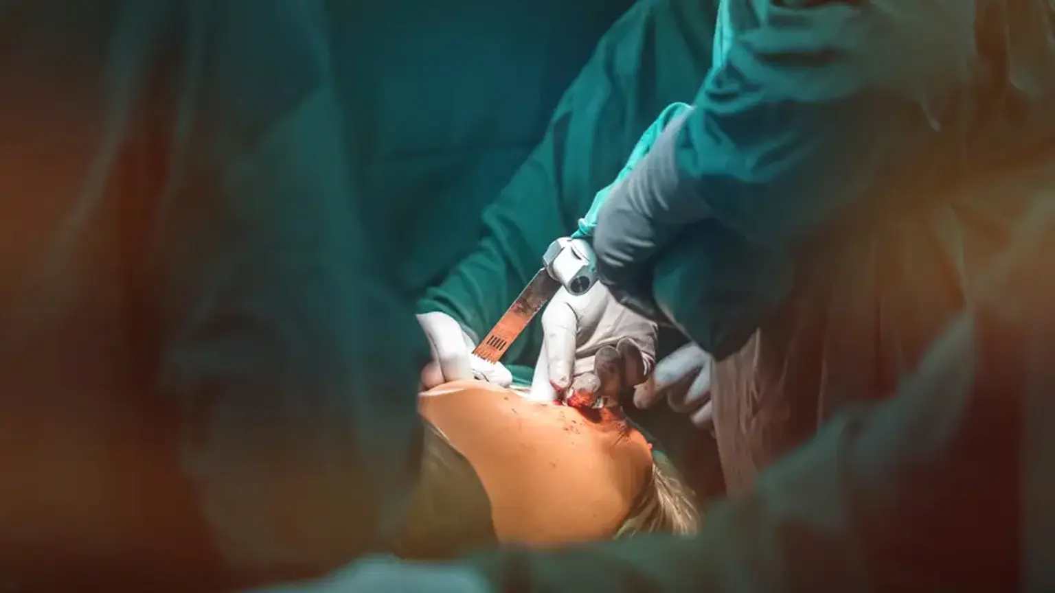 Hemiarthroplasty for intertrochanteric fracture