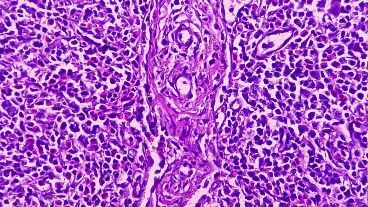 Hodgkin Lymphoma Program