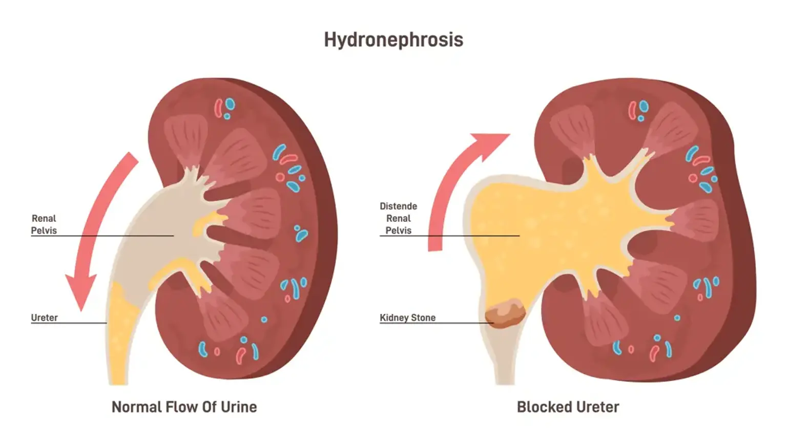 Hydronephrosis Management