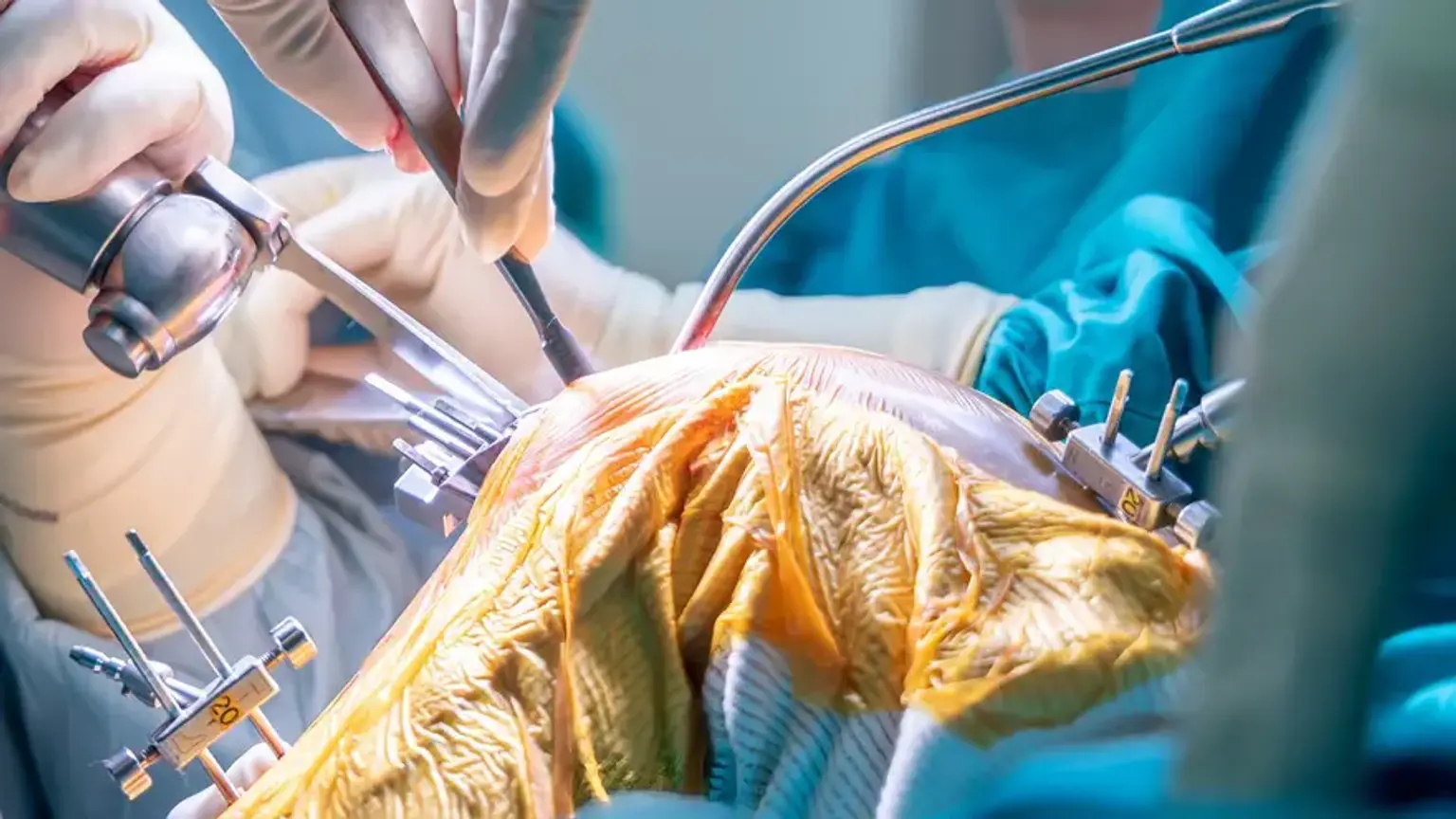 Medial opening wedge high tibial osteotomy