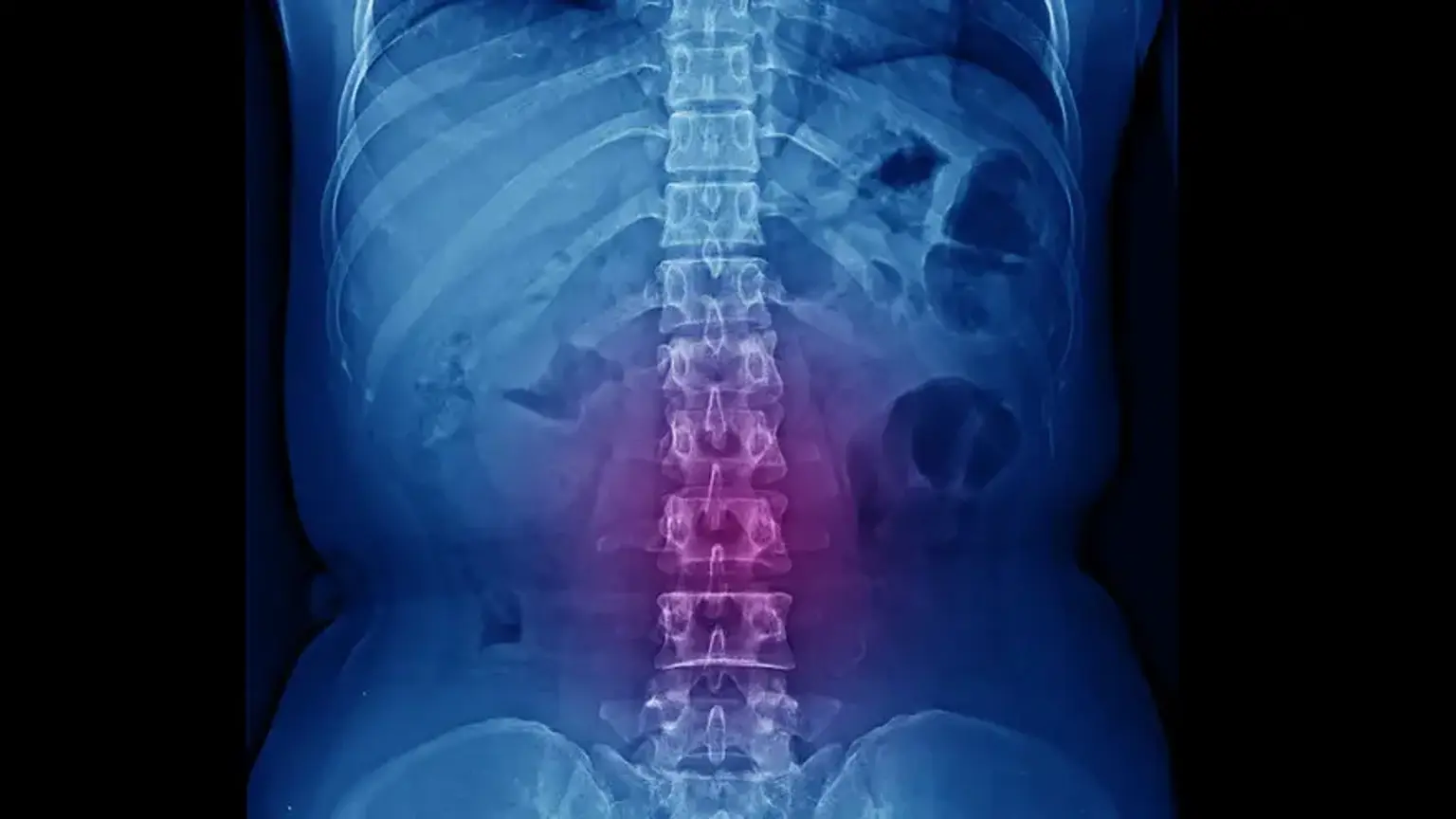 Posterior Lumbar Interbody Fusion 