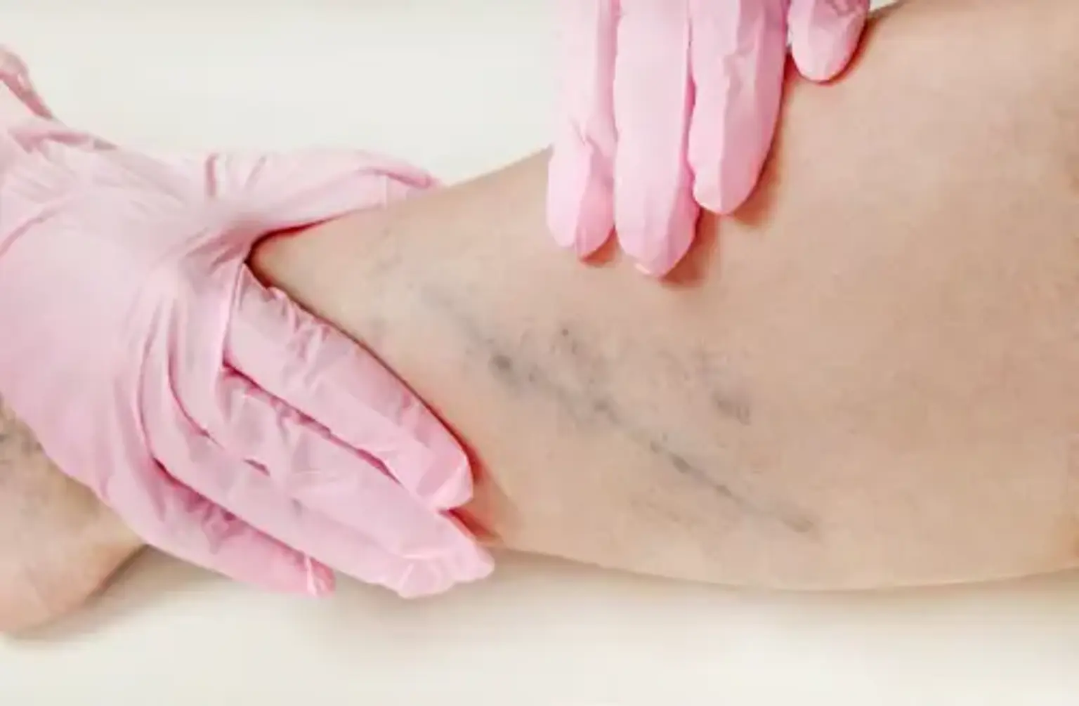 Lymphovenous Bypass