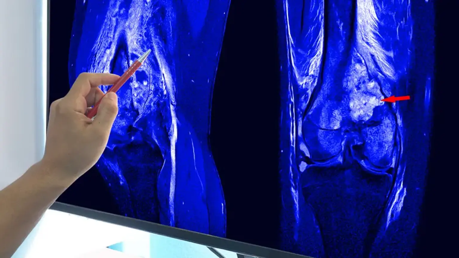Multi modal osteosarcoma management