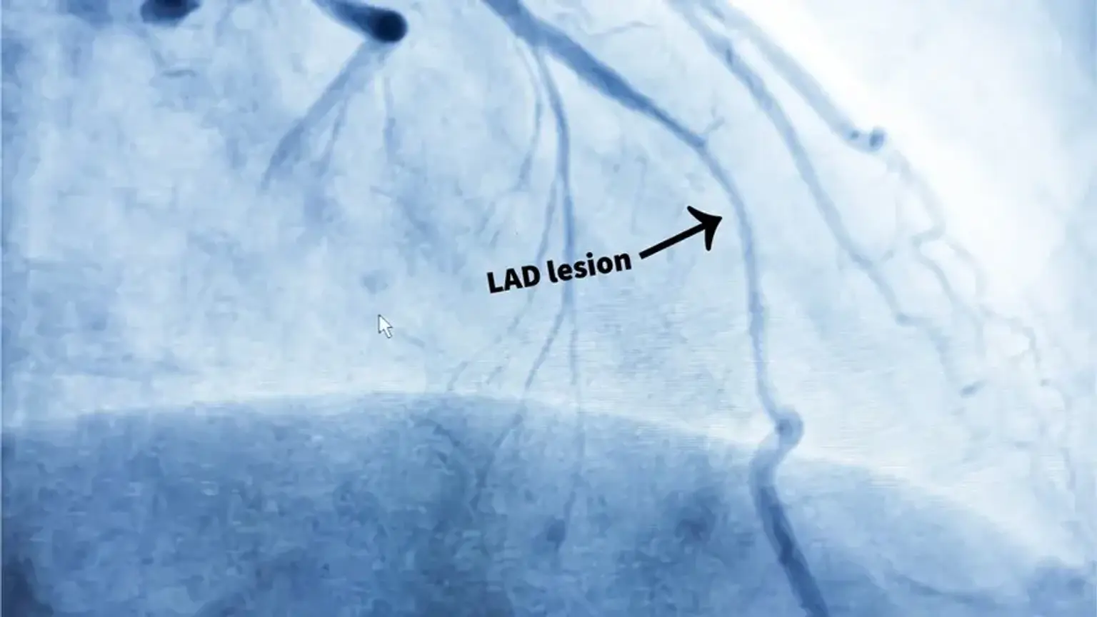PCI  Coronary Angioplasty