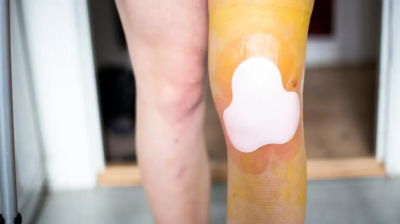 Unicompartmental knee arthroplasty