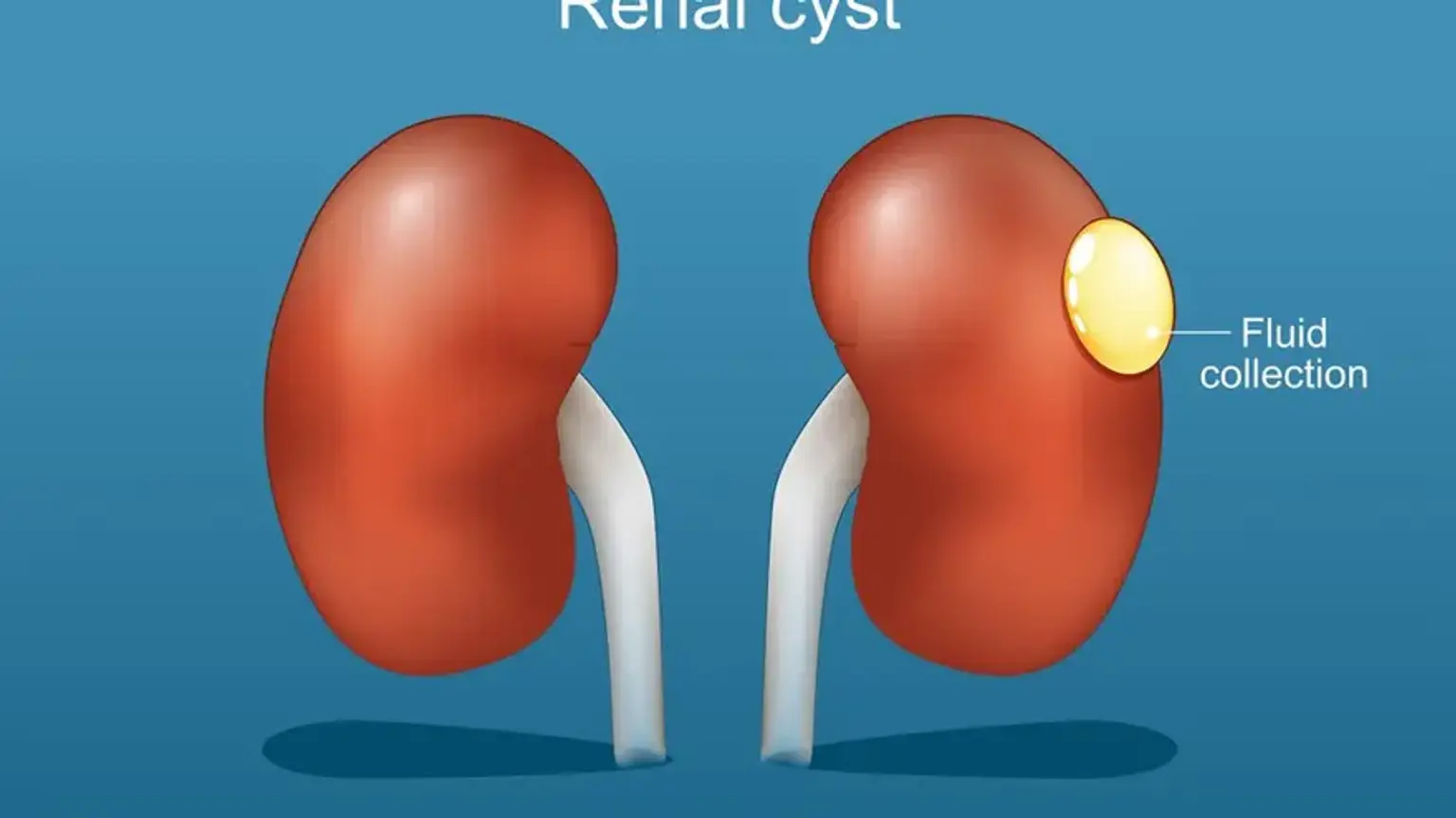 Hypertension and Kidney Disease