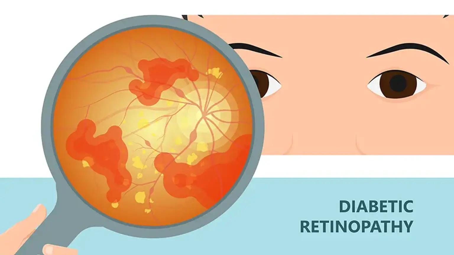 糖尿病视网膜病变