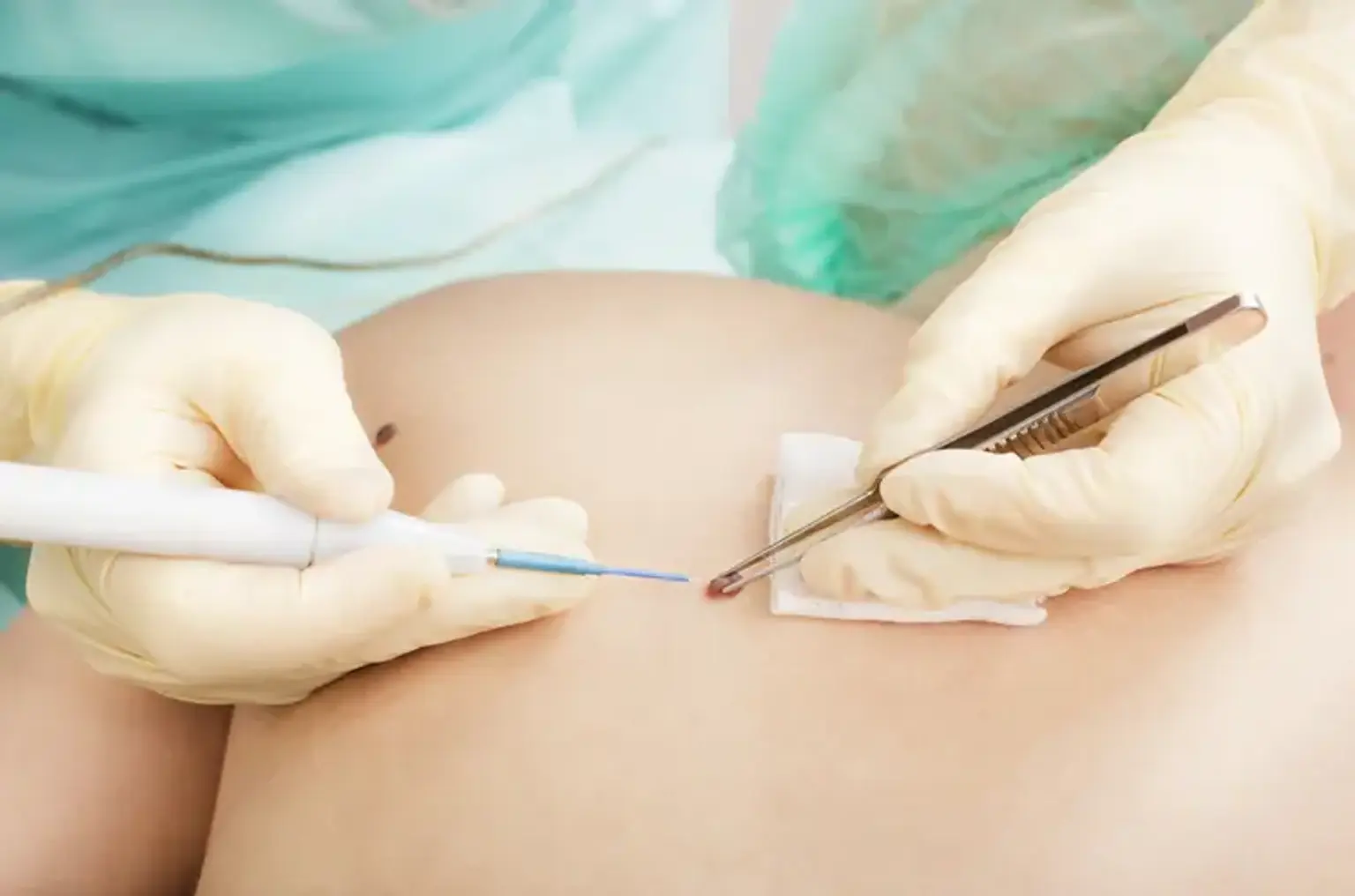 Excisional Skin Surgery