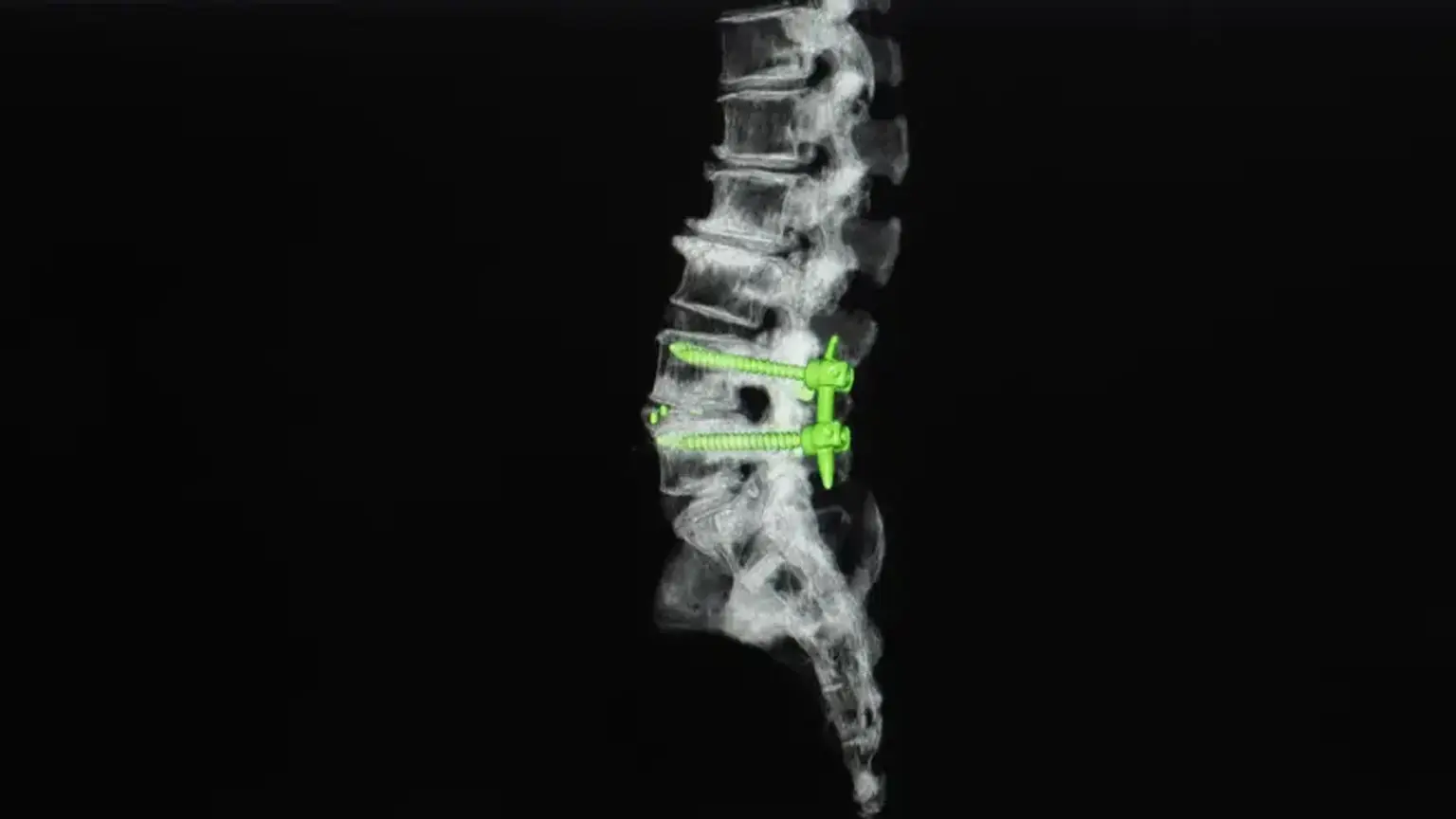 Transforaminal Lumbar Interbody Fusion 