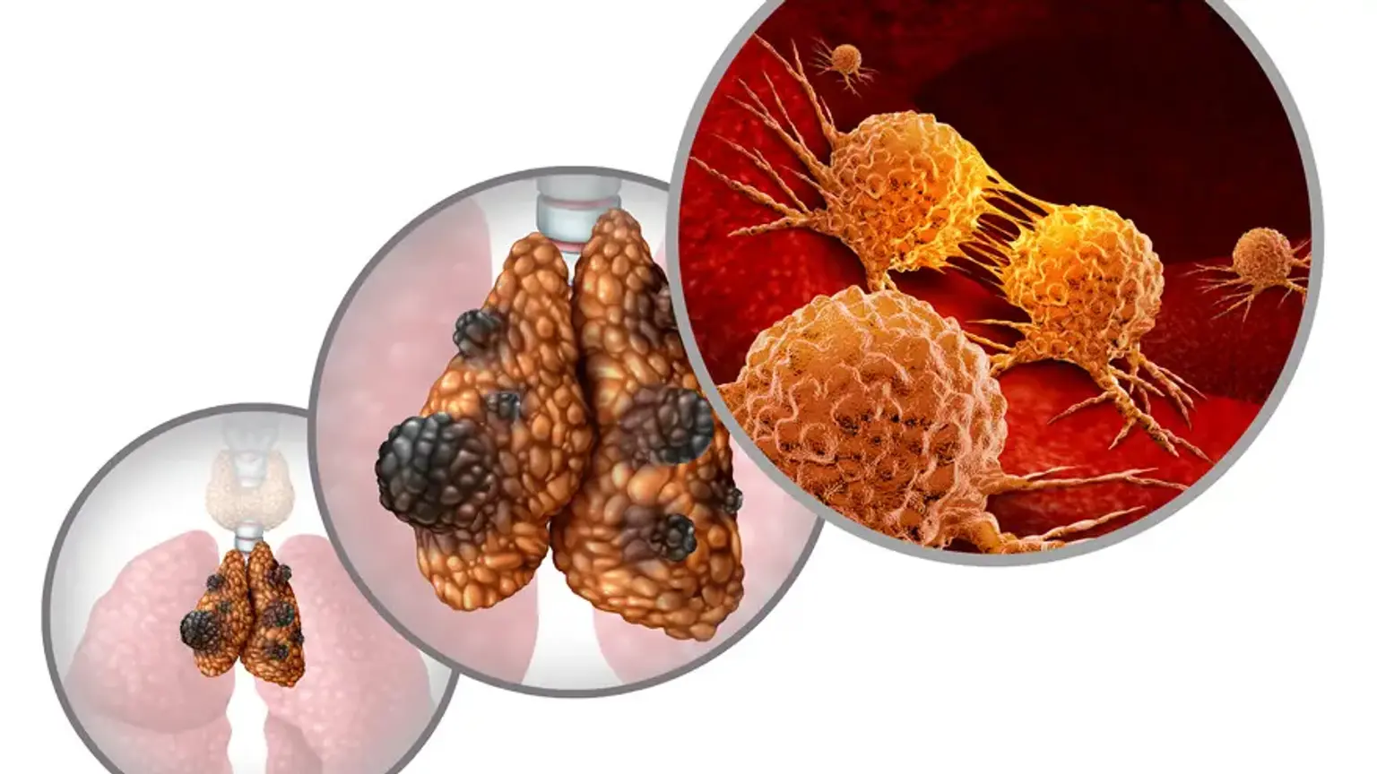 Thymic Cancer Program