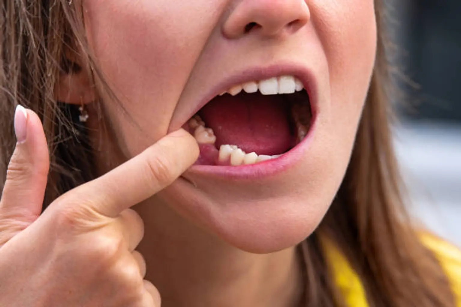 Extração dentária