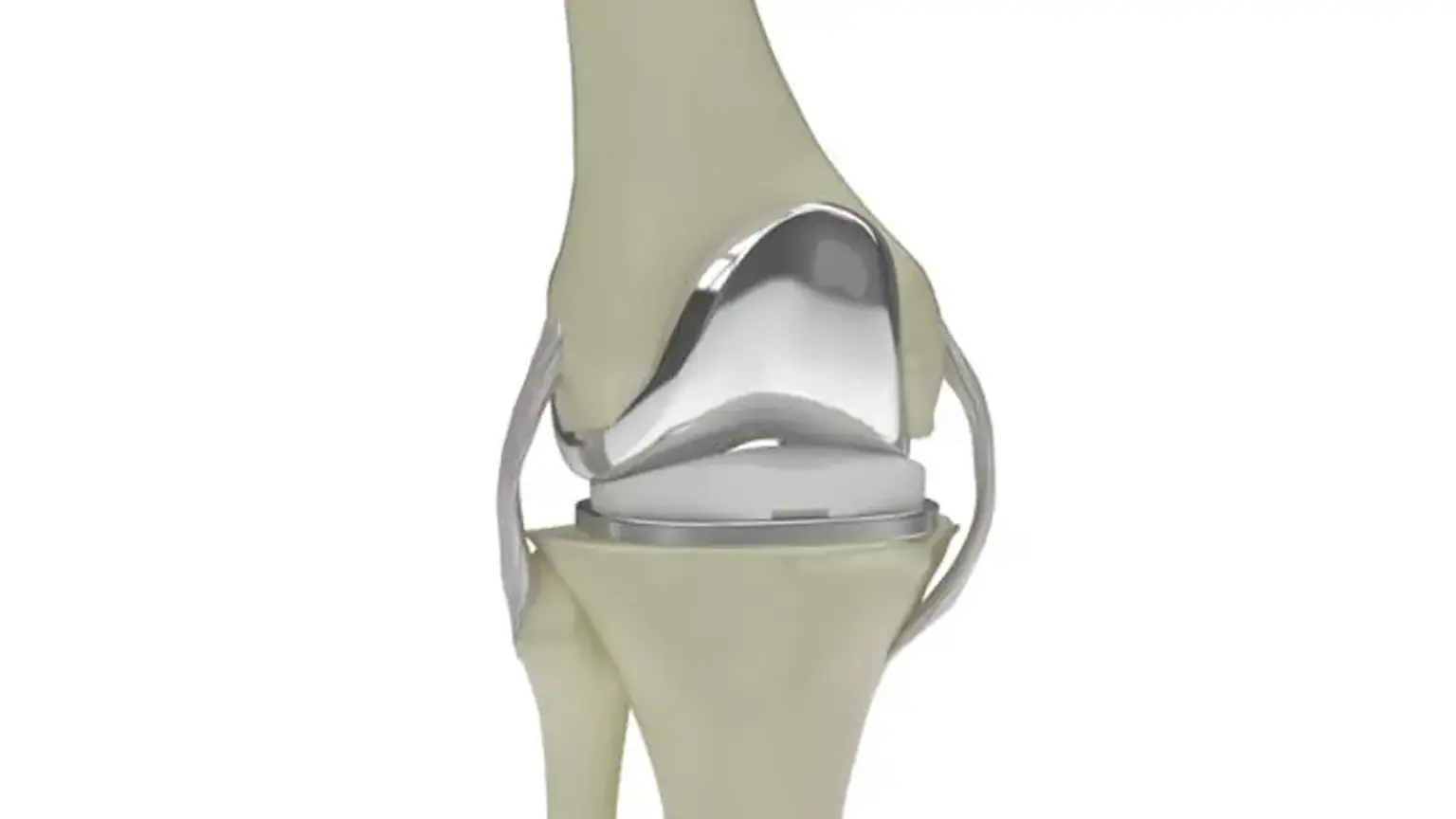 Revision total knee arthroplasty