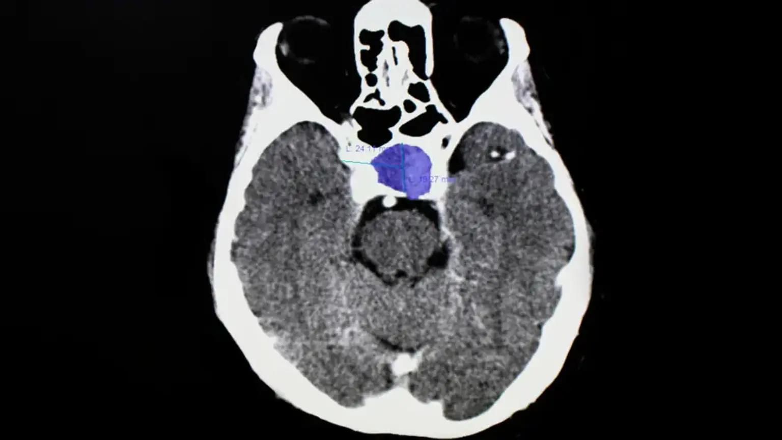 Pituitary Tumor Evaluation and Management