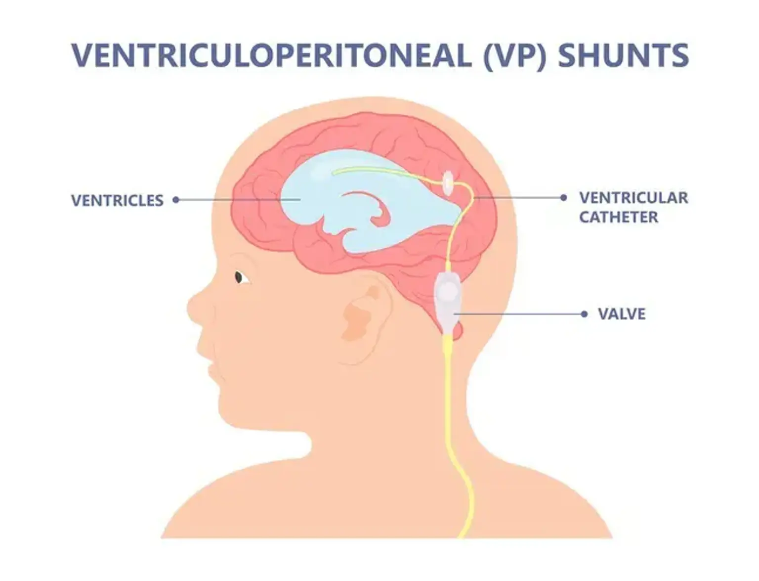 Ventriculoperitoneal  Shunt Placement