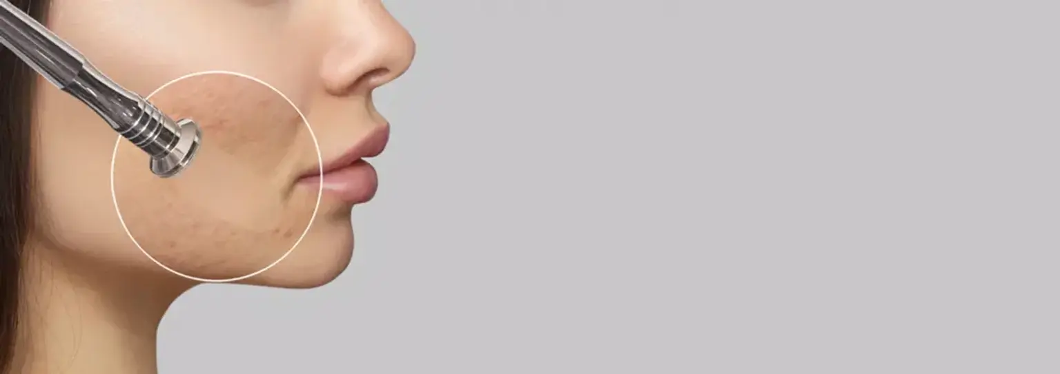 laser-treatment