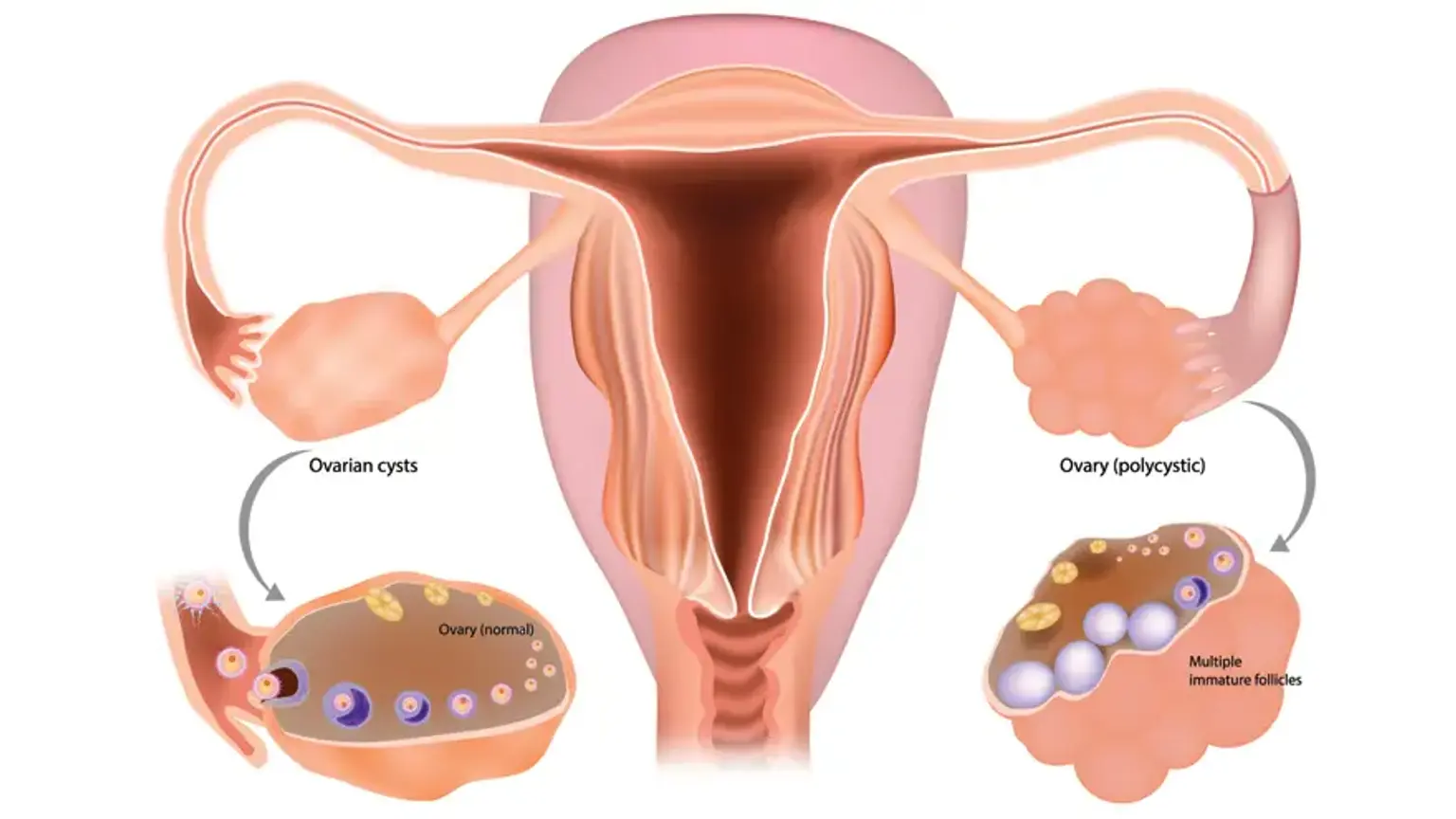 Cyst on ovary PCOS