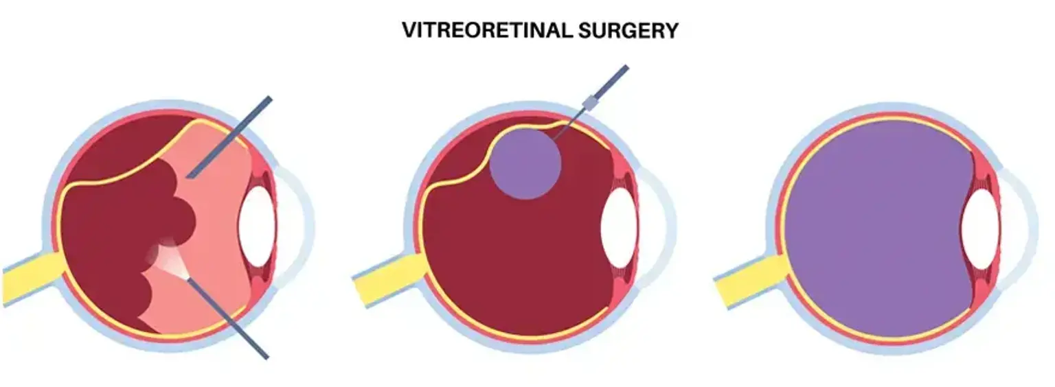 A Patient's Guide to Affordable Retinal Care in South Korea
