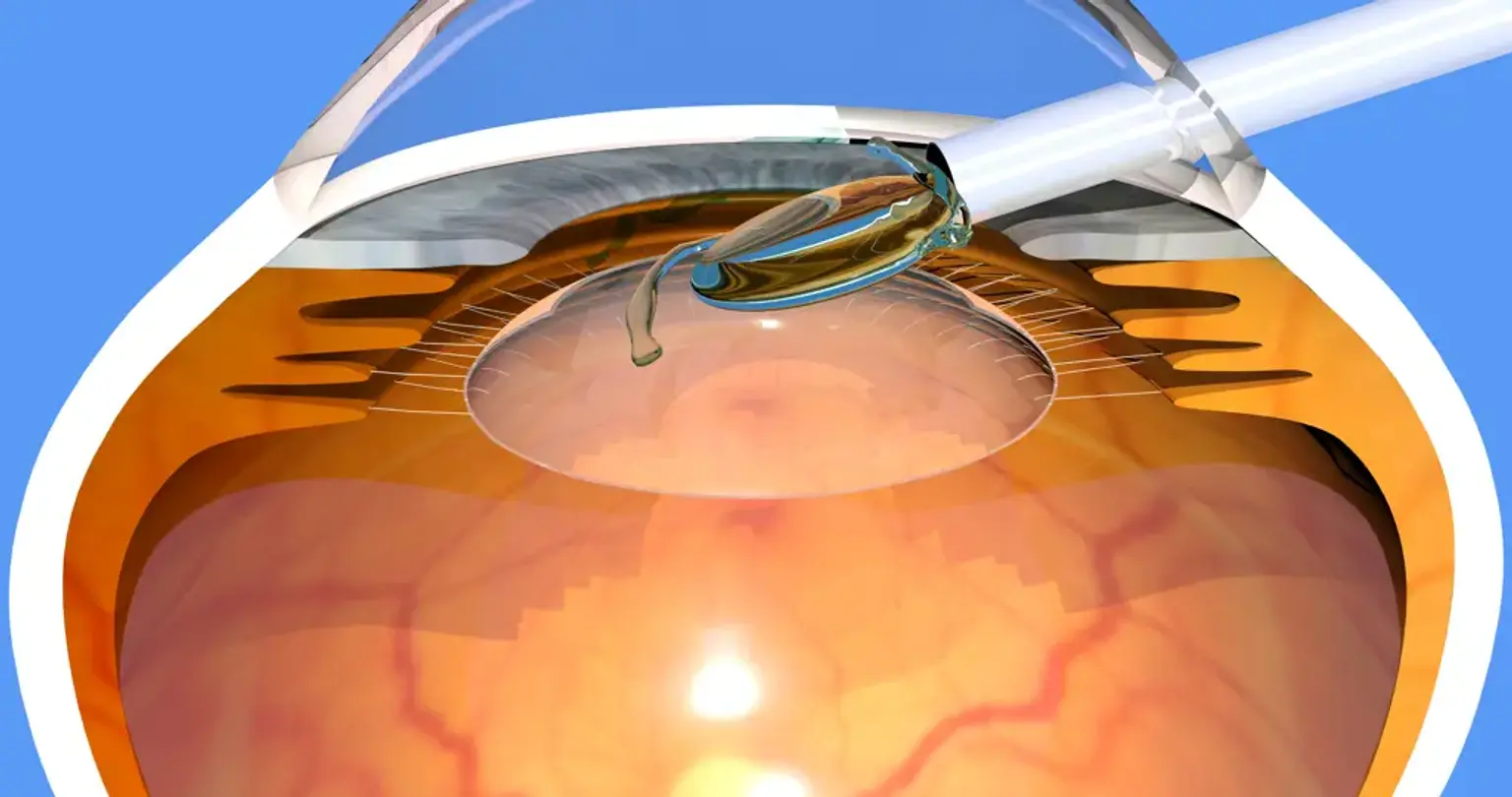 What is Phakic Intraocular Lens (PIOL) Implant Surgery in Korea?