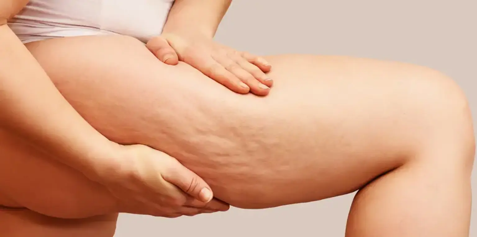 Cellulite