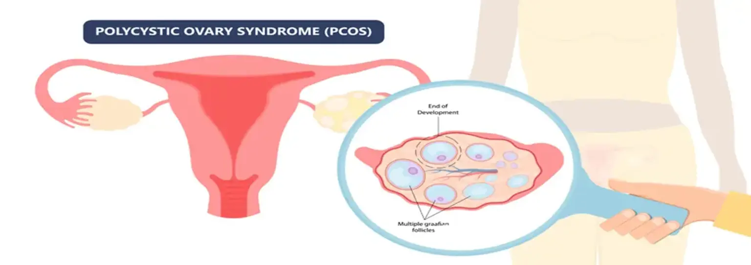 How to Get a Uterine Polyp Removal in Korea: A Step-by-Step Guide