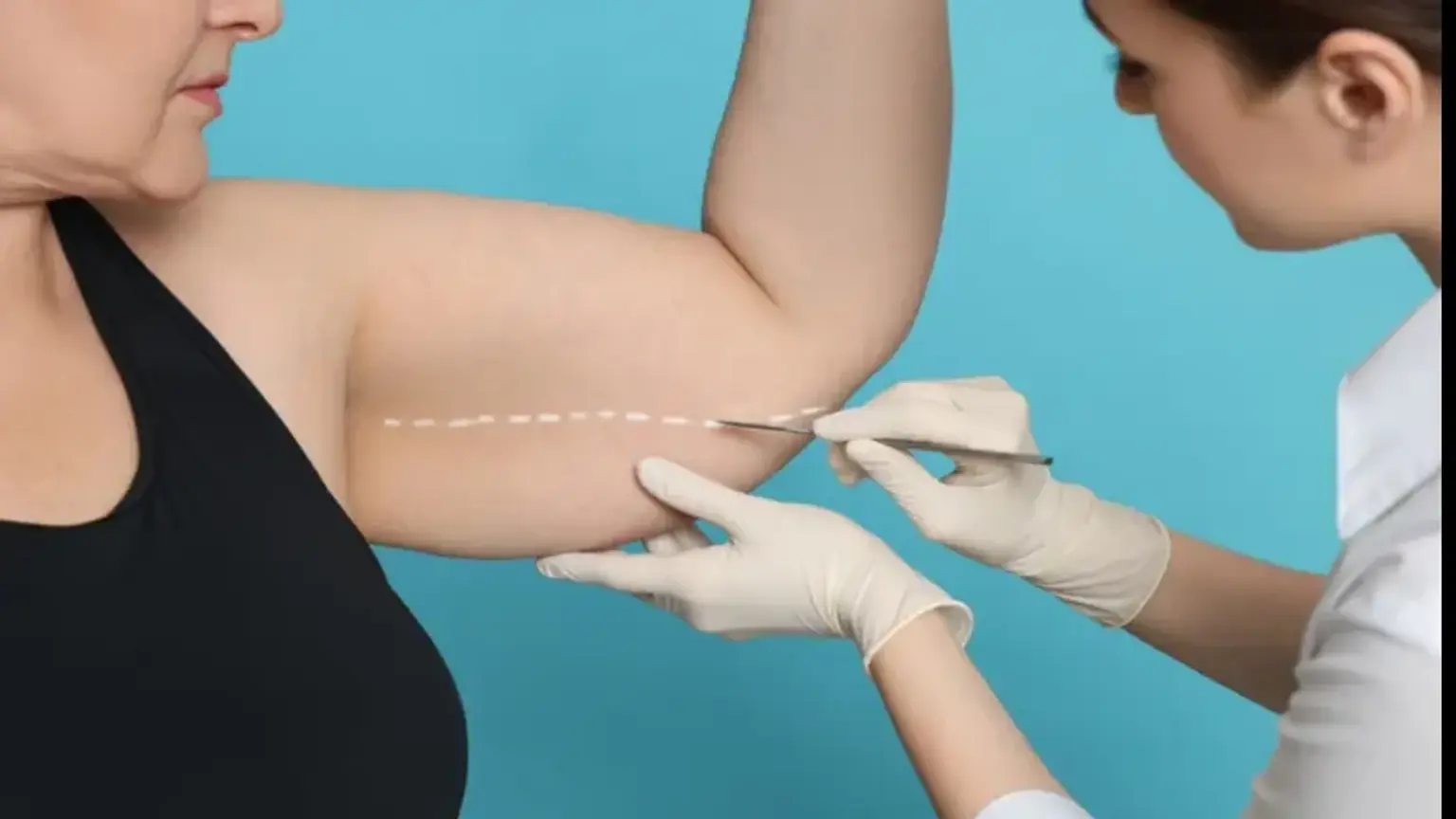 Inner Arm Liposuction