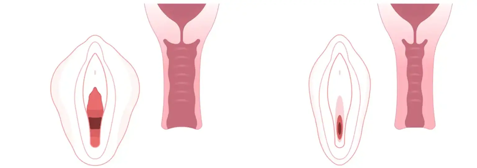 Vaginal Aesthetic Procedures