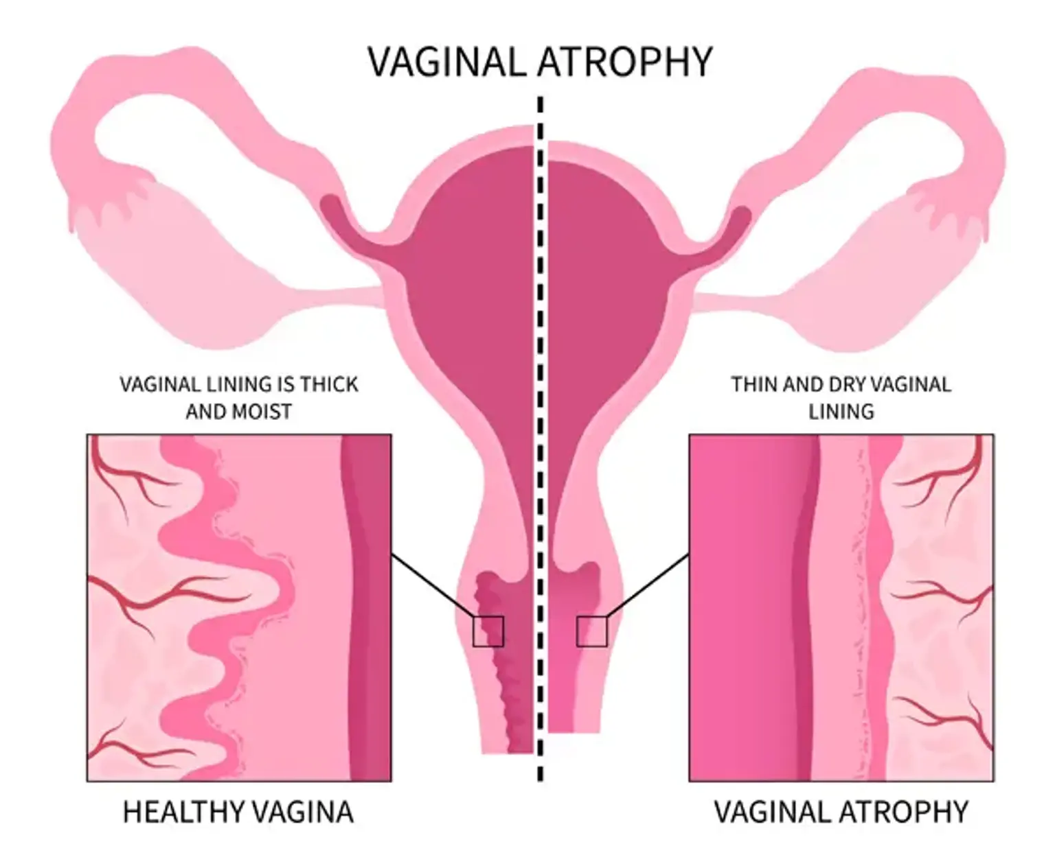 Vaginal atrophy