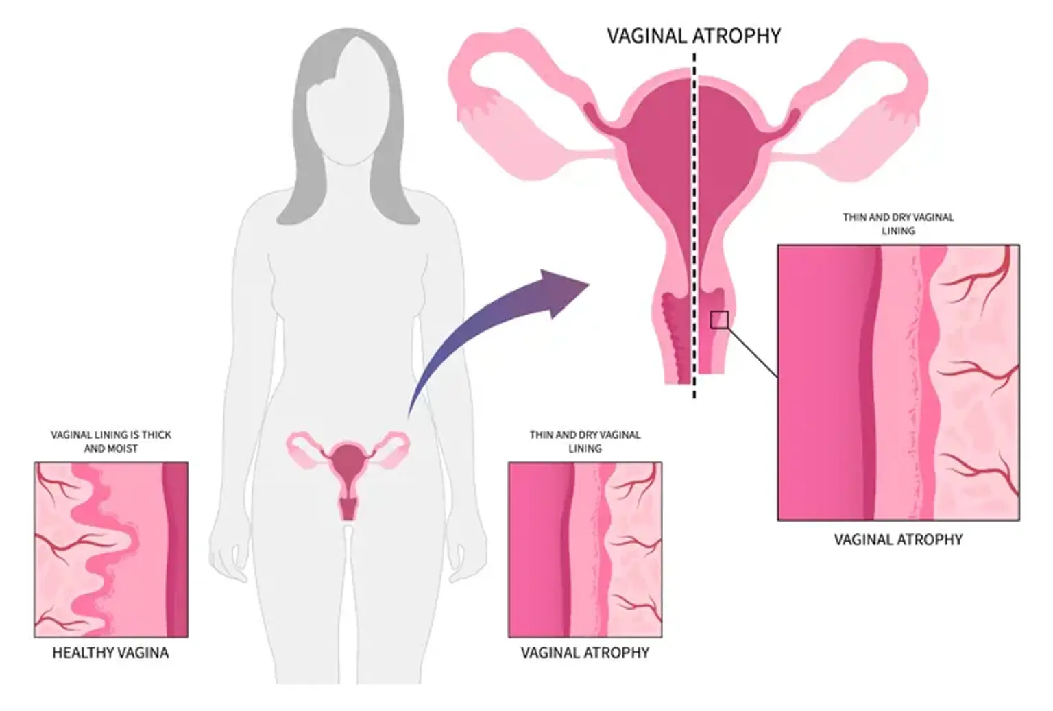 Vaginal atrophy