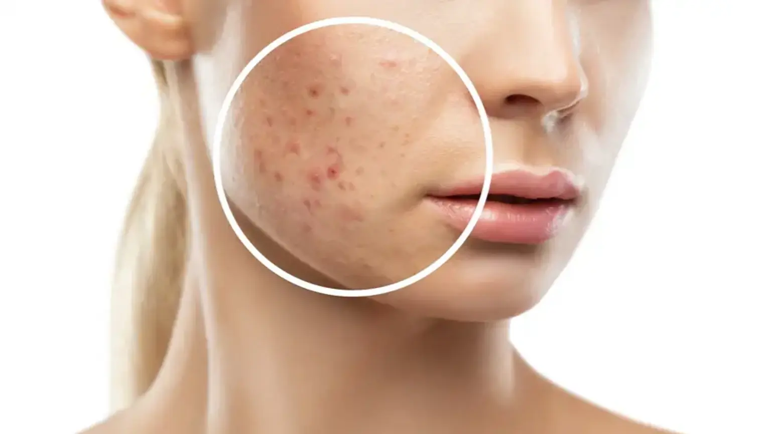 RF microneedling