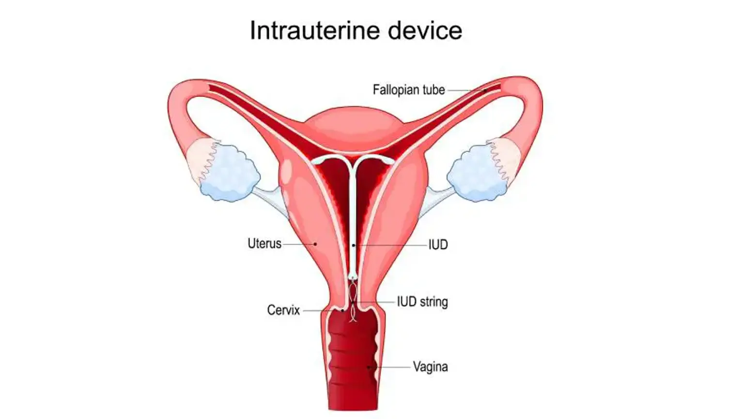 The Procedure of IUD Insertion
