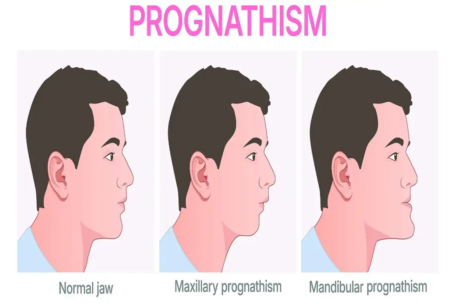 The Guide to Prognathism Treatment Underbite in Korea A Clinical ...