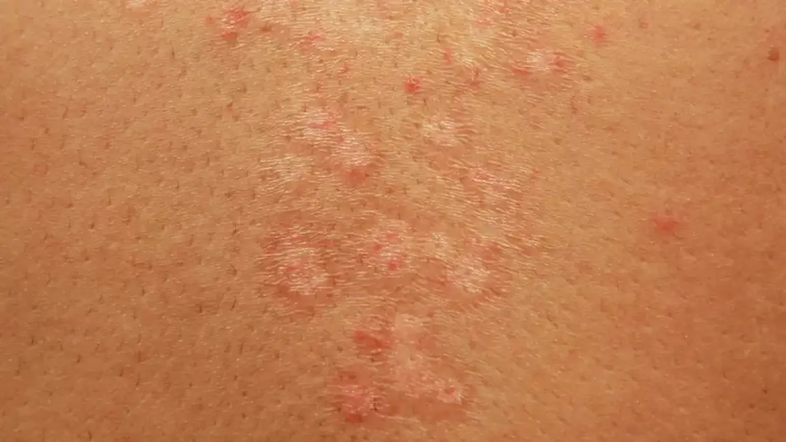 Fungal Infection Treatment in Mira Road & Mumbai
