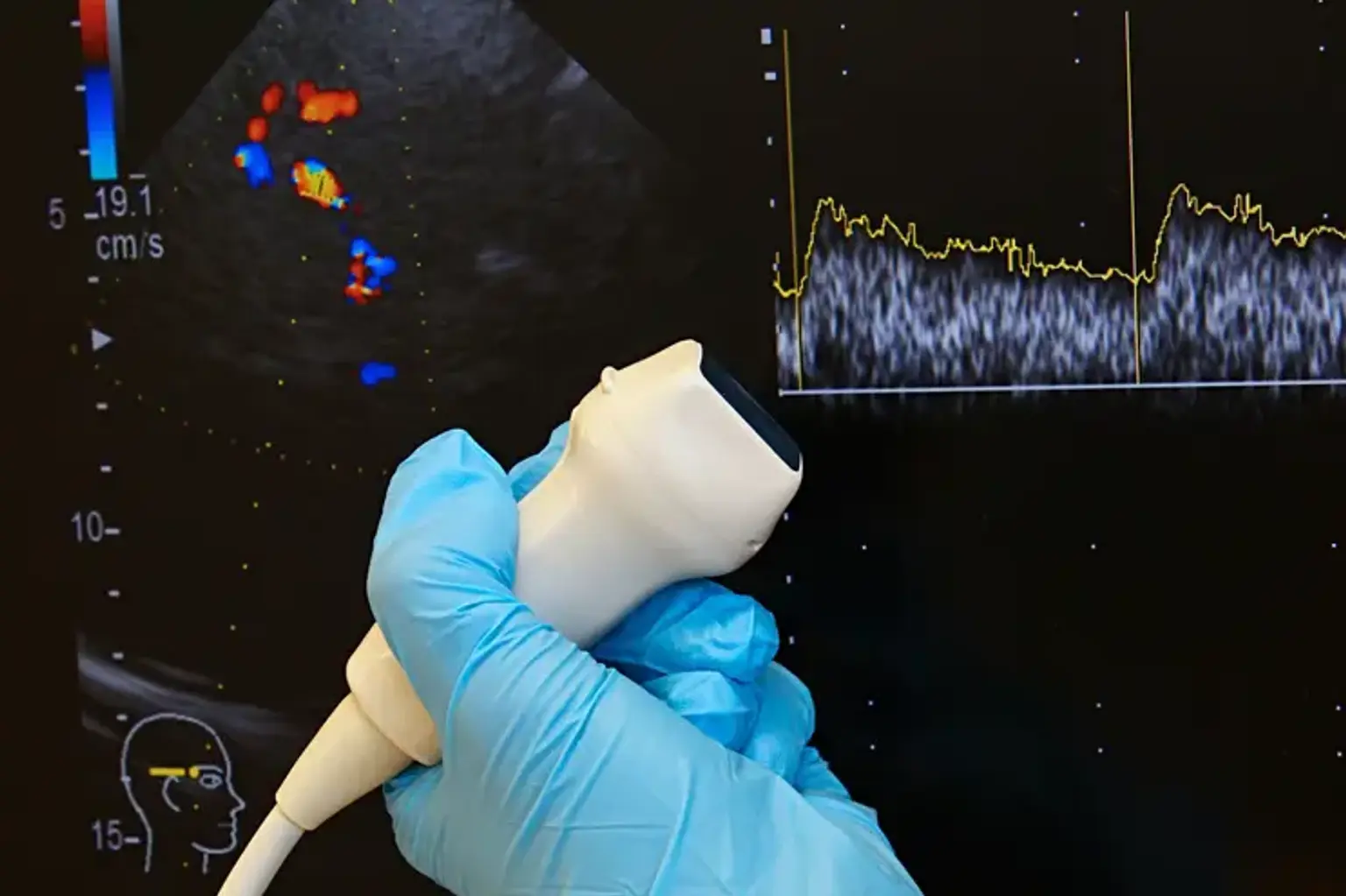 TCD Ultrasound for Brain Blood Flow Monitoring