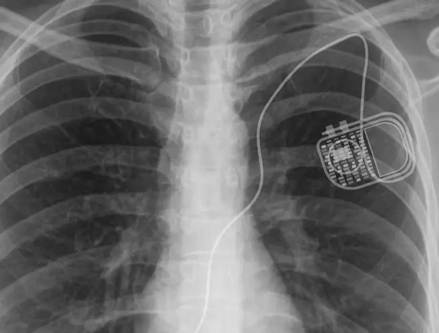 ICD Implantation Surgery