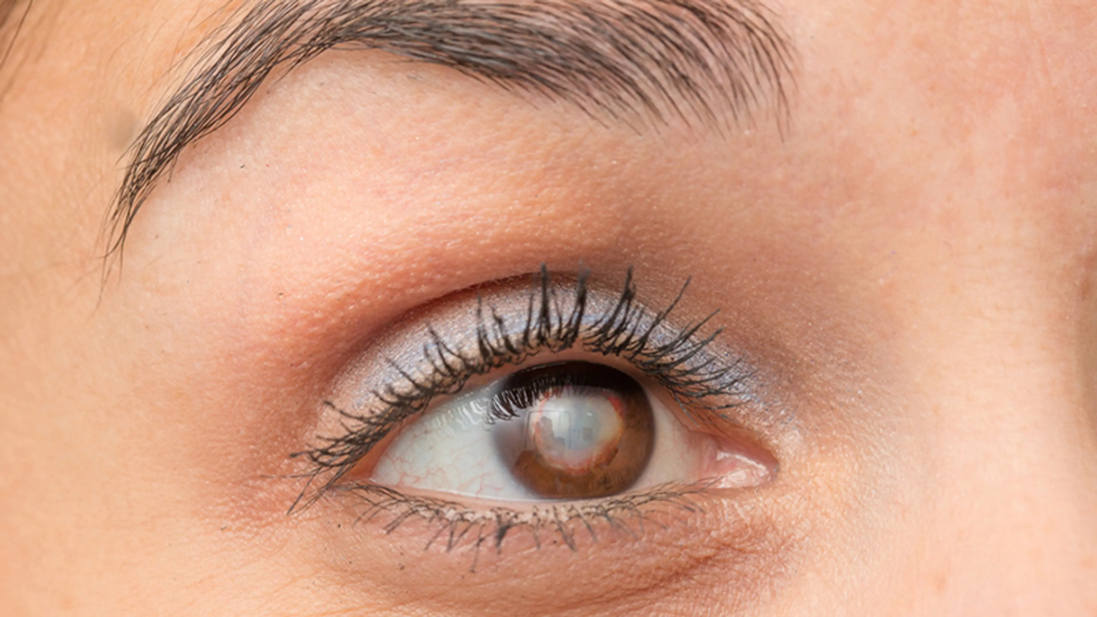 白内障