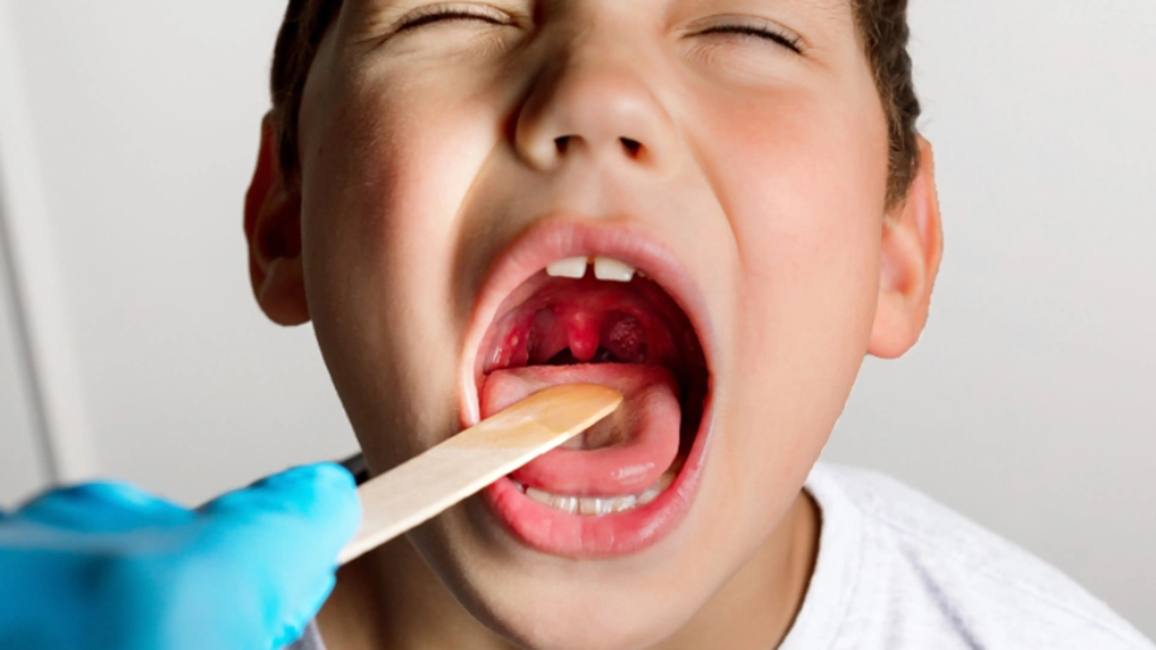 儿童扁桃体问题