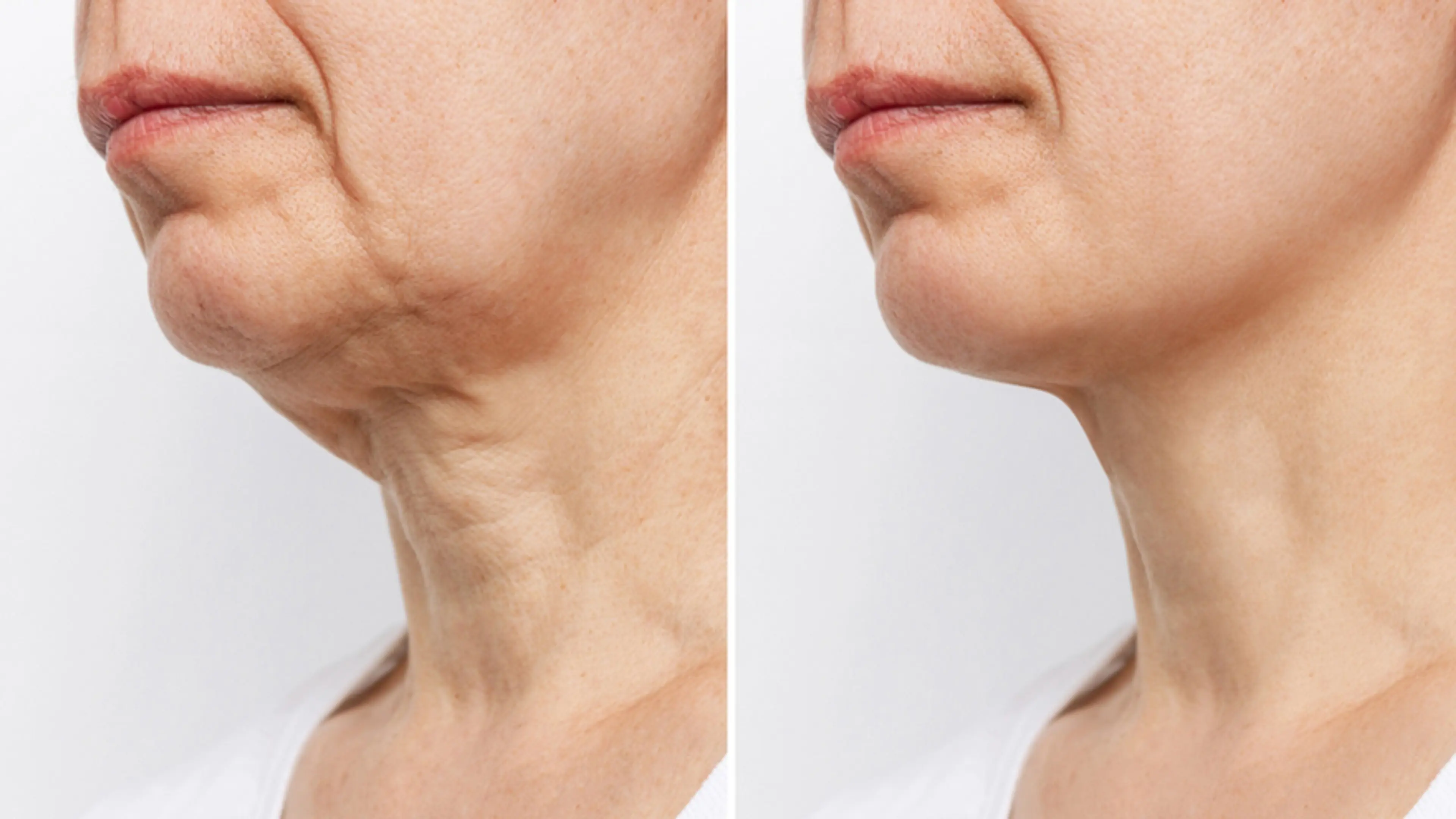 Articles | Neck Lift vs Neck Contouring: Which is Right for You?