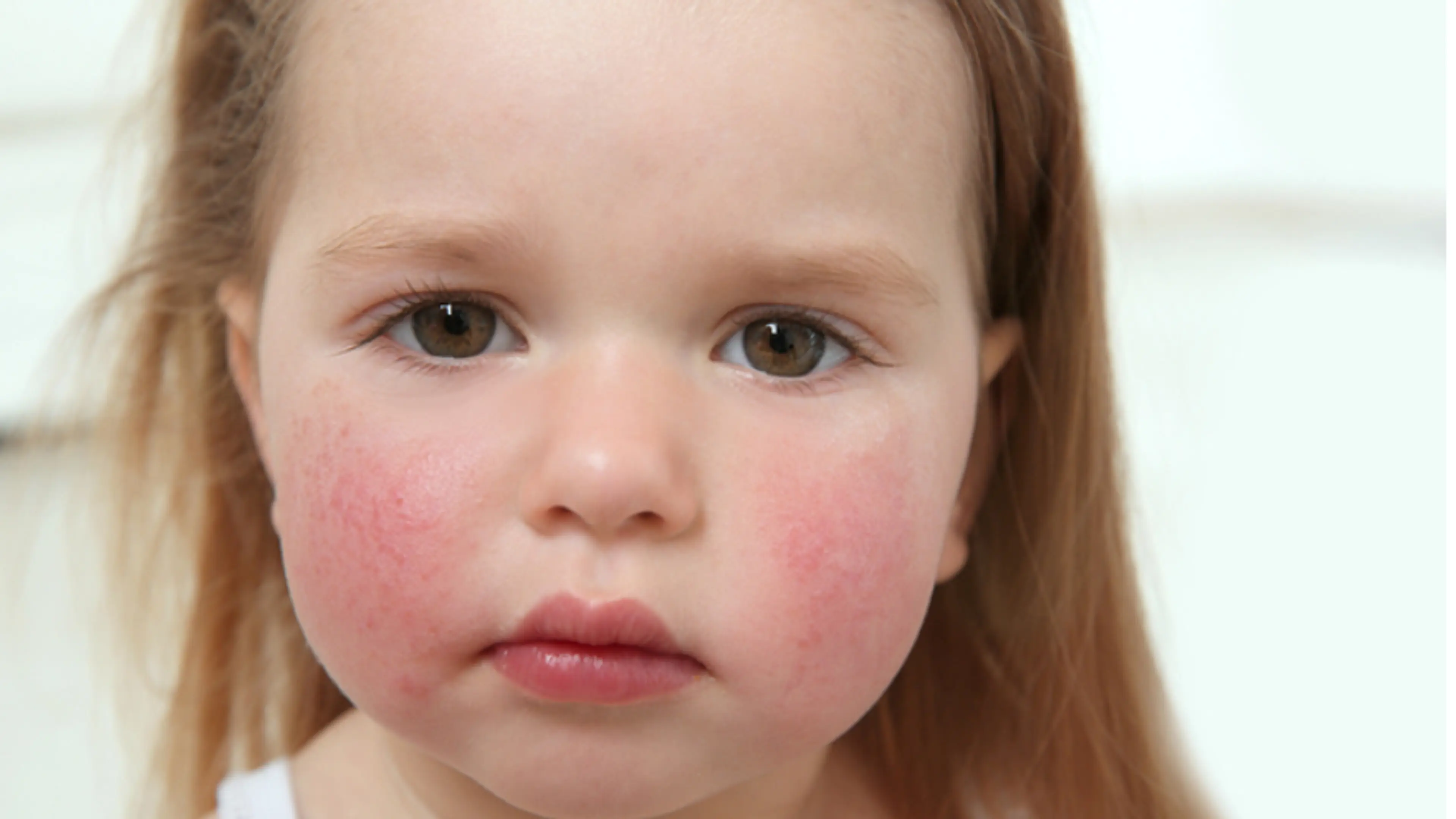 Childhood Allergies