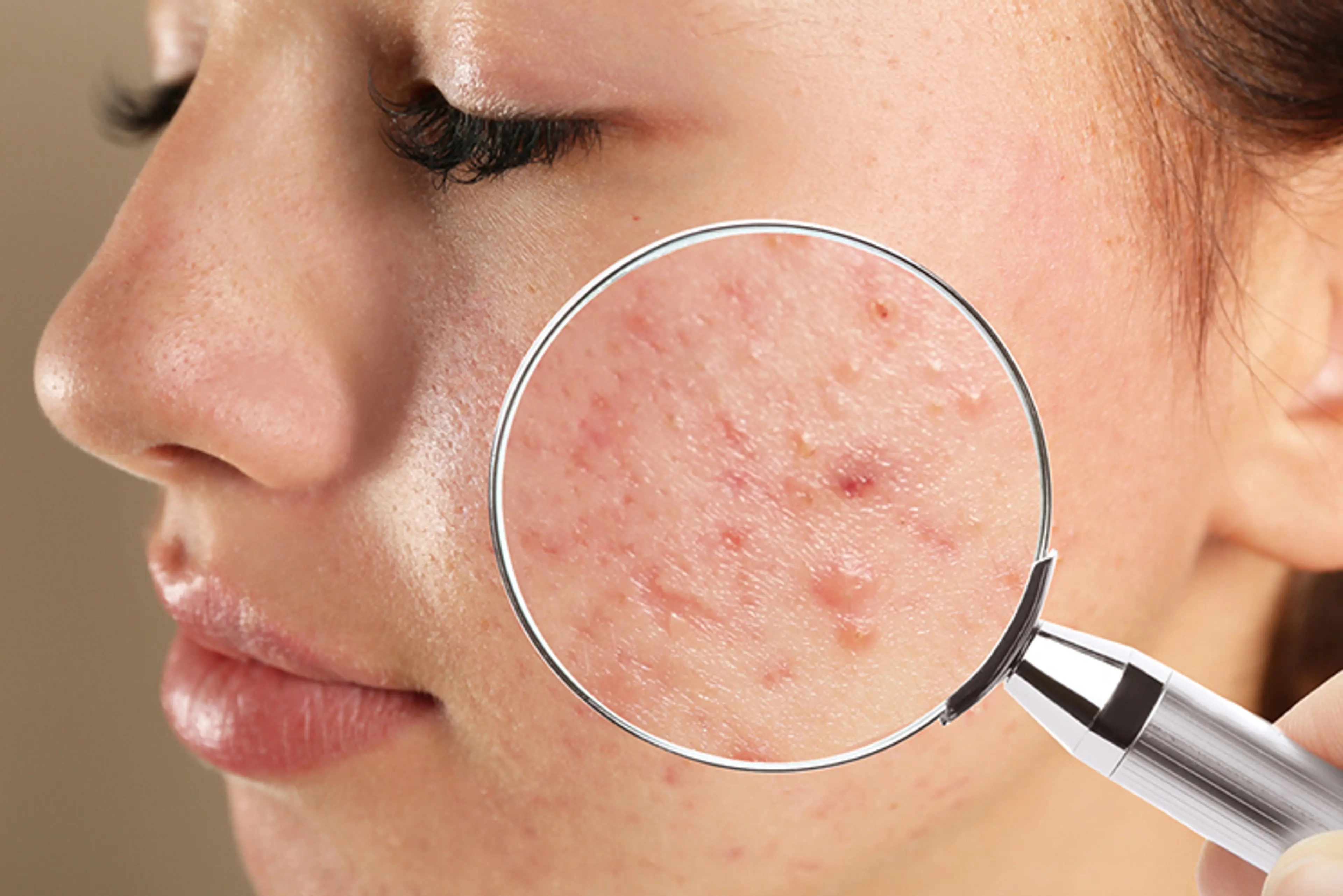 Who Should Consider the LHA LALA Peel?