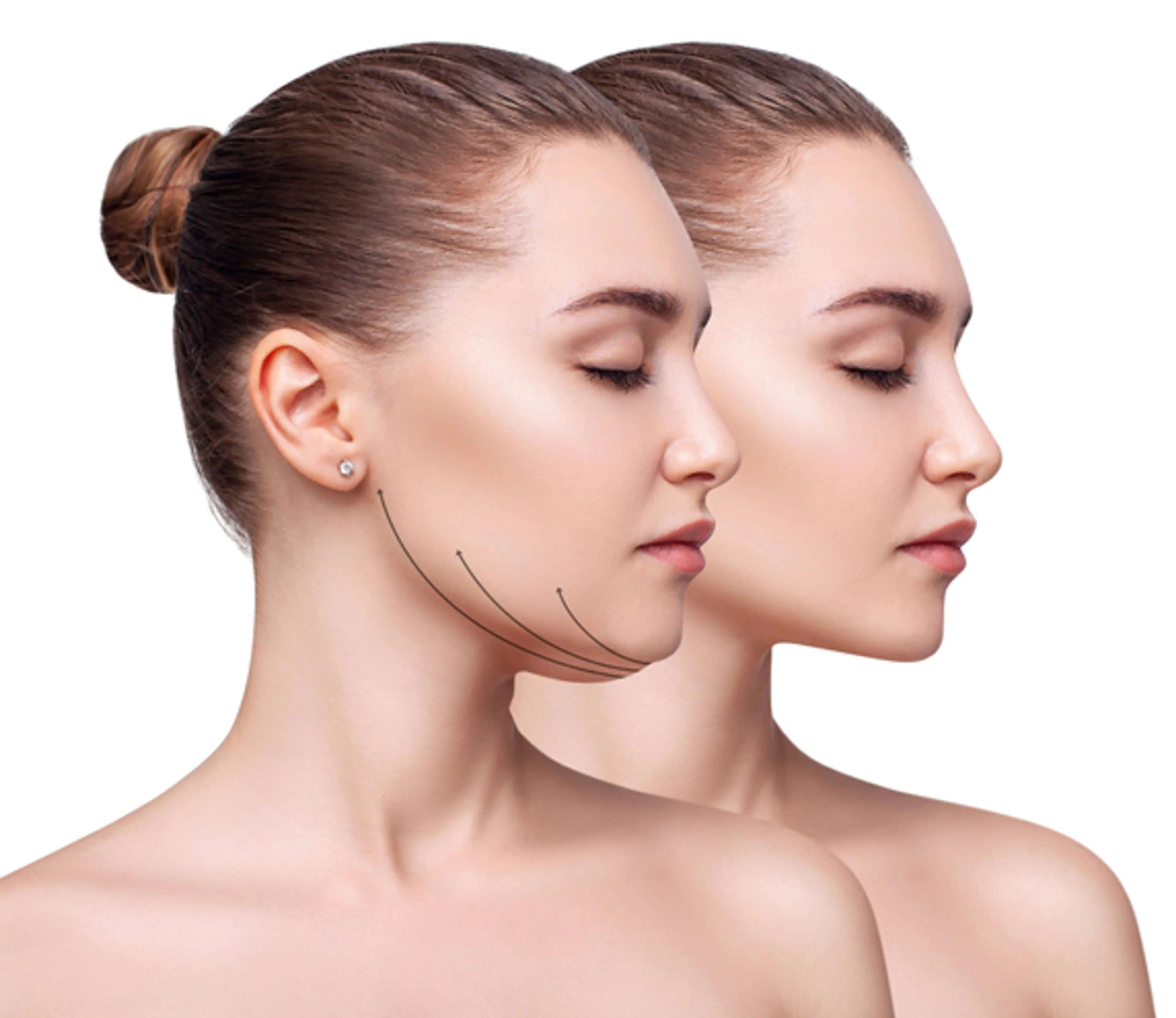 Facial Liposuction