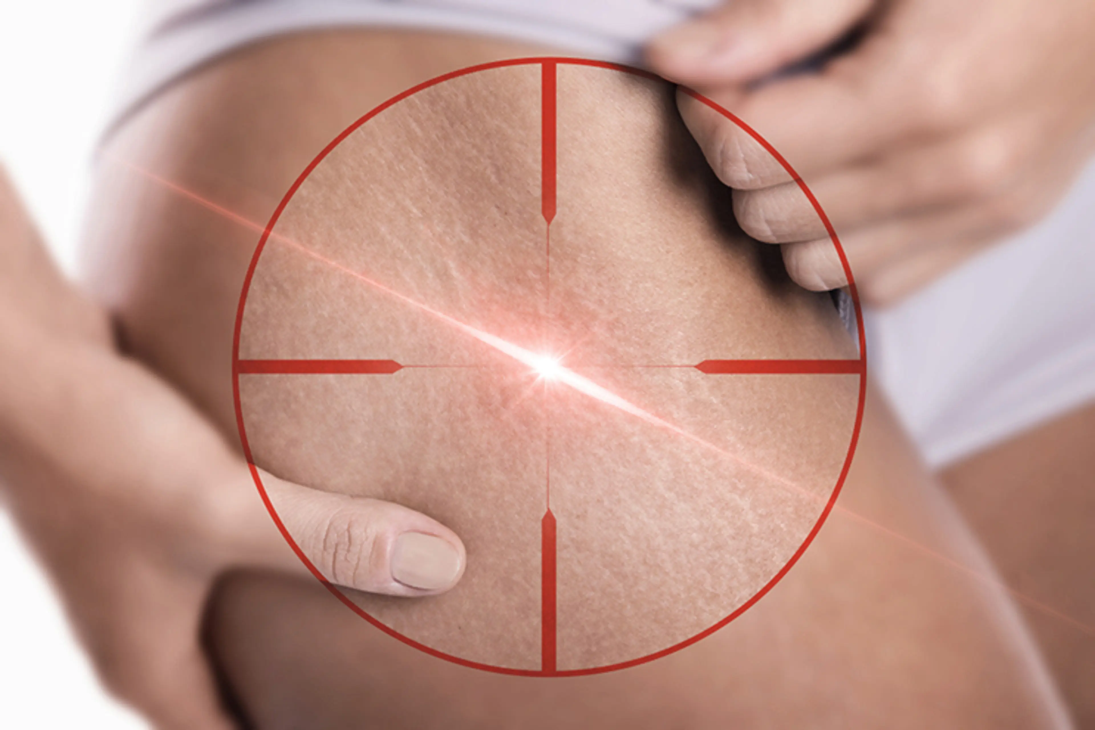 Best Laser Treatments for Stretch Marks