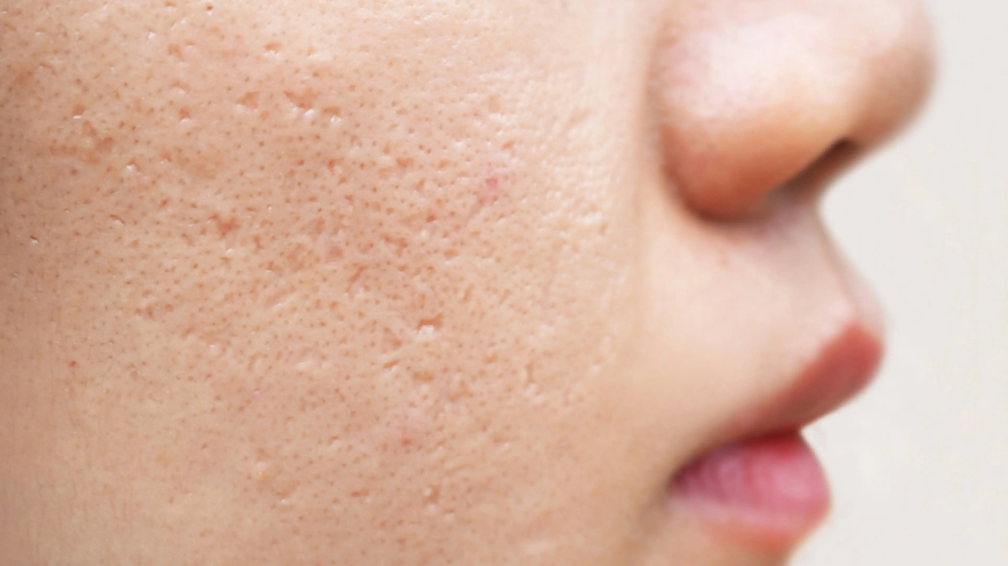 Acne