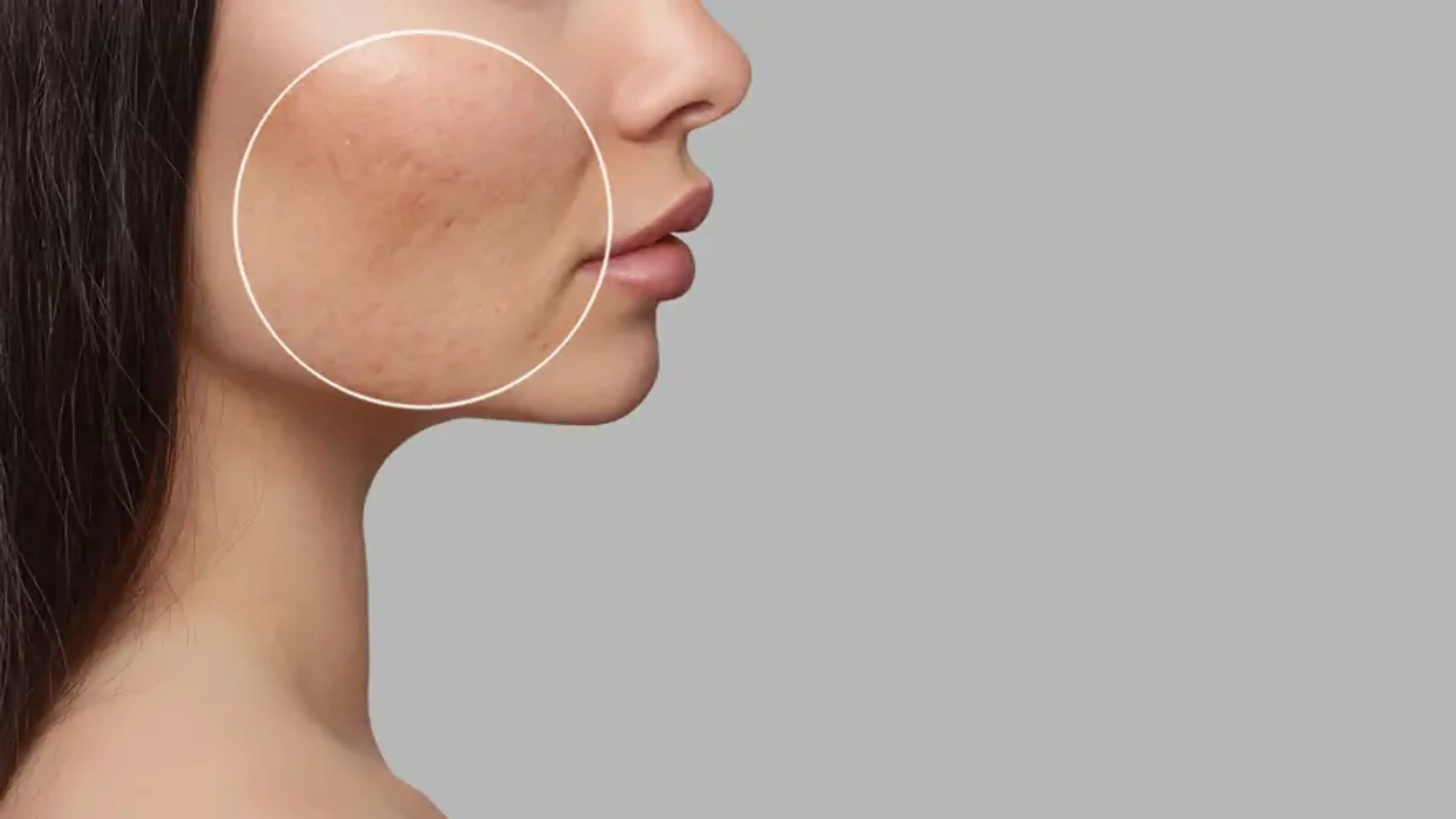 acne scars