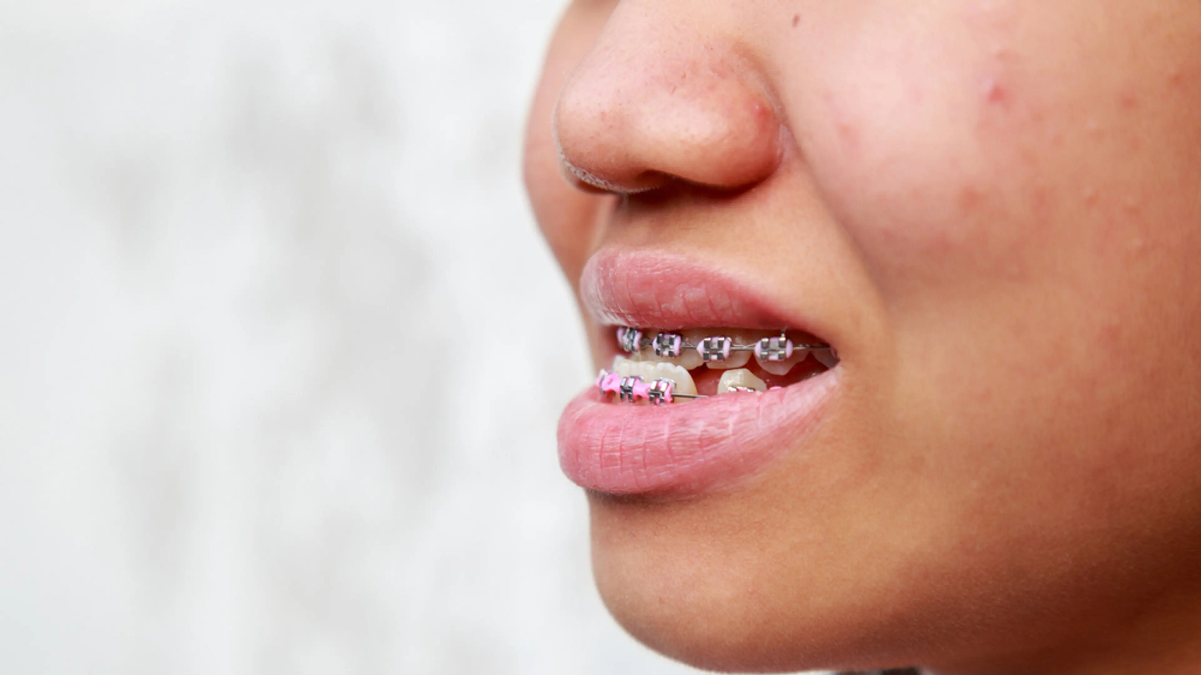 Braces and Sports