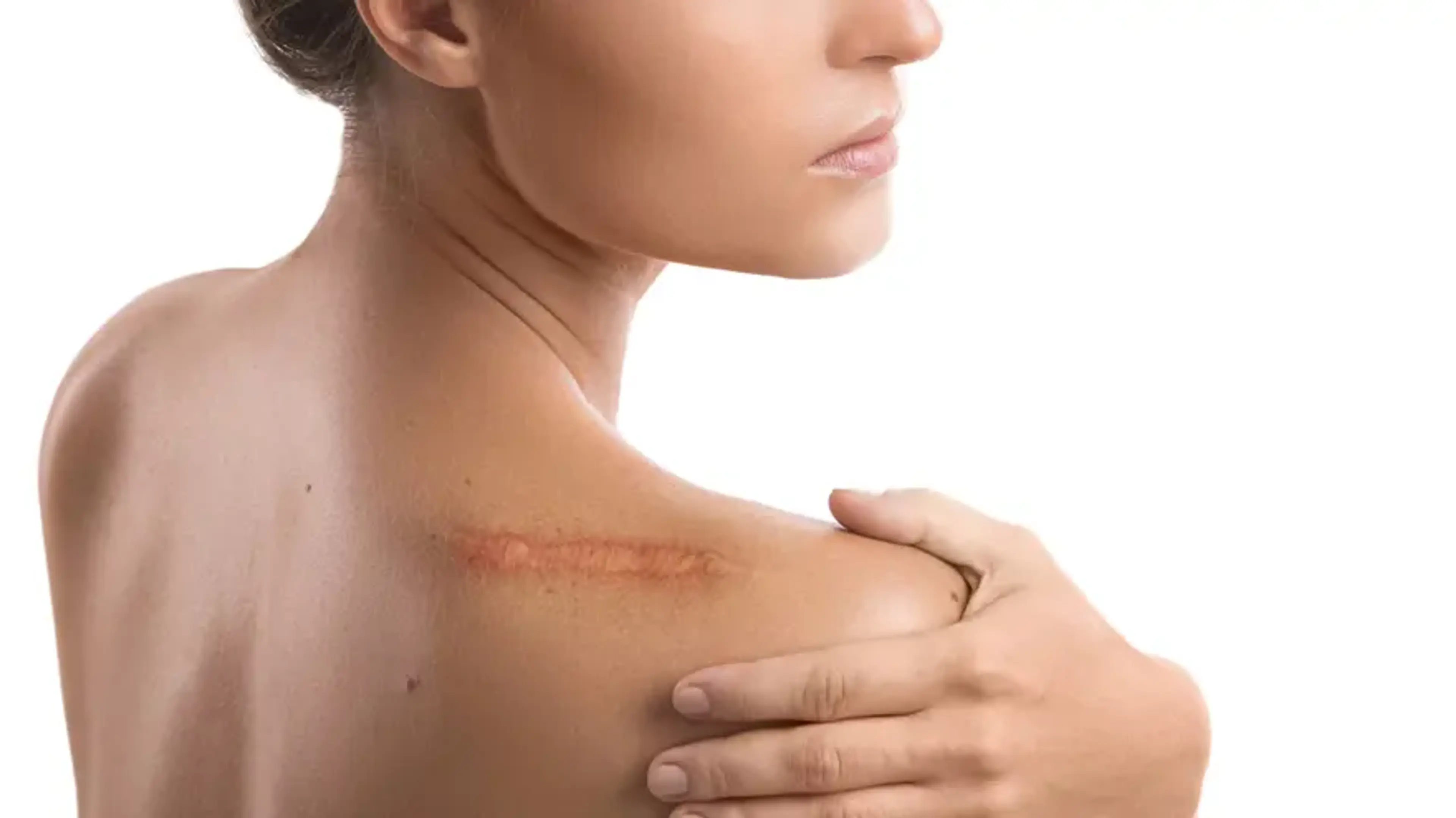 Woman showing a raised surgical scar on her shoulder, illustrating cancer and plastic surgery scar treatment before therapy.
