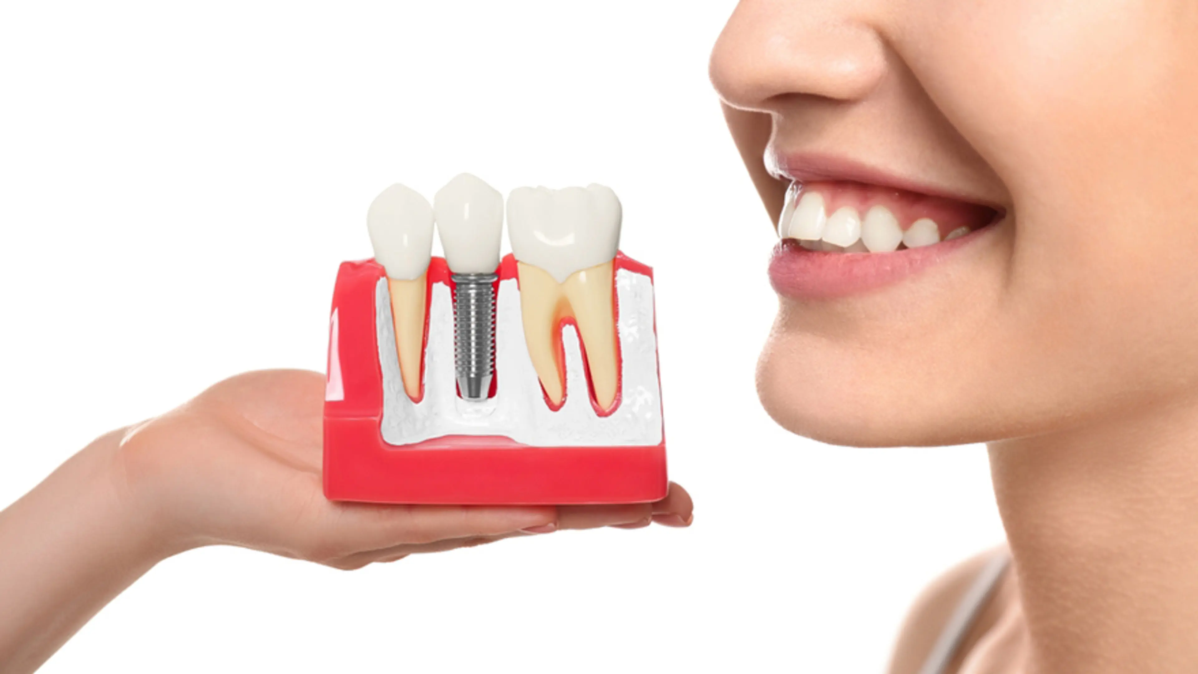 Dental Implant