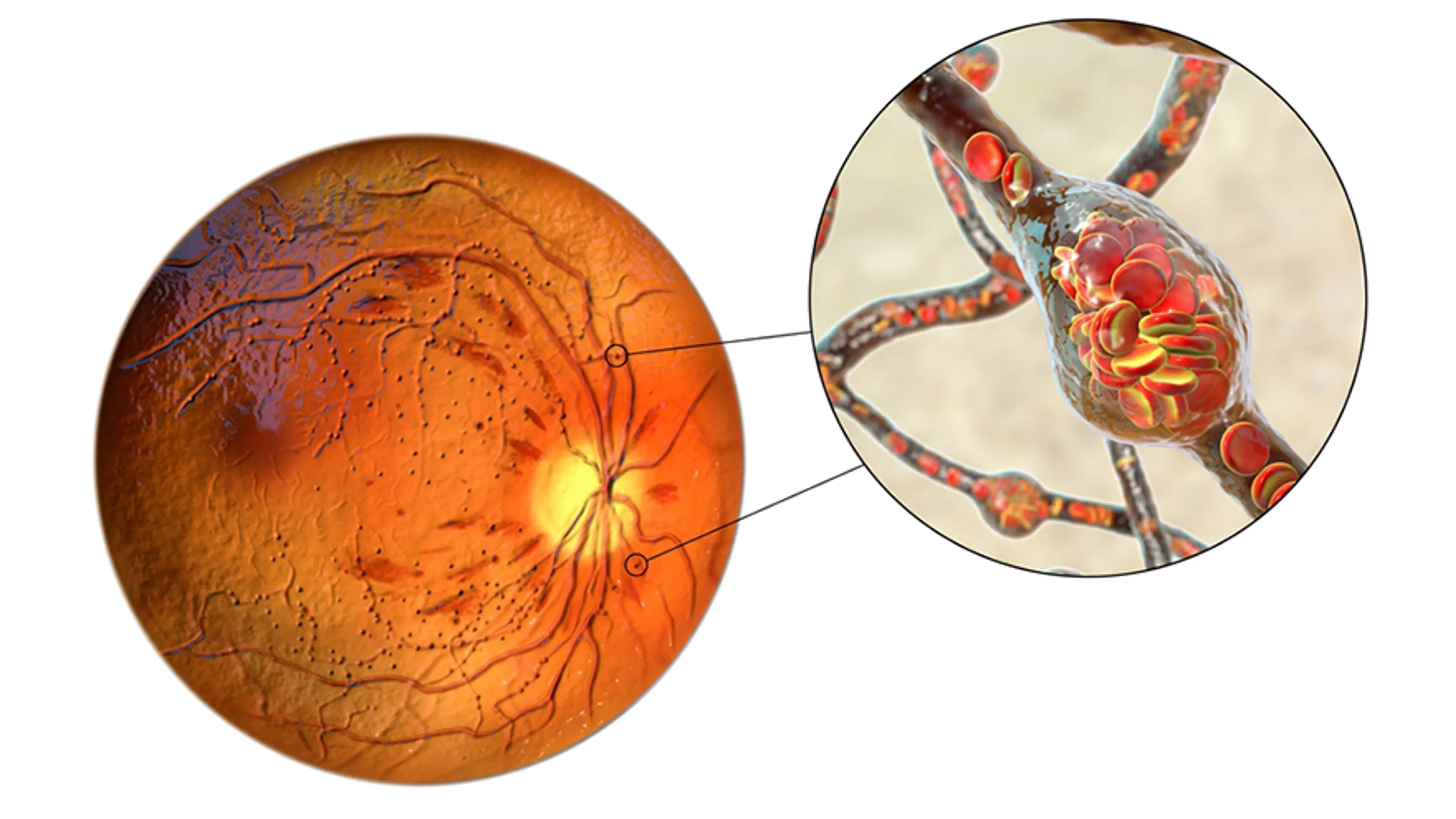 糖尿病视网膜病变